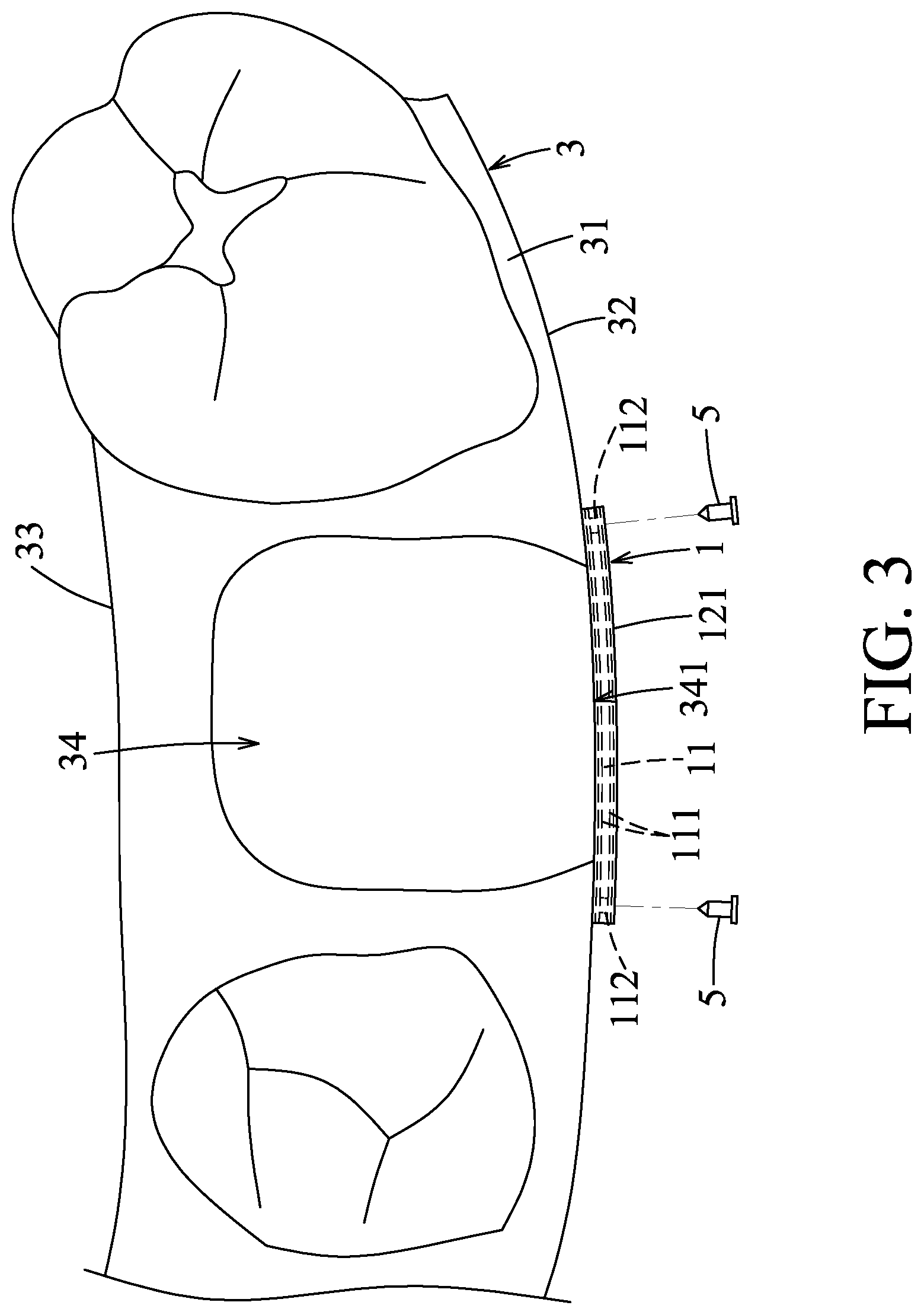 Patent US11771559 Figure 3 – Support device and method of using the same
