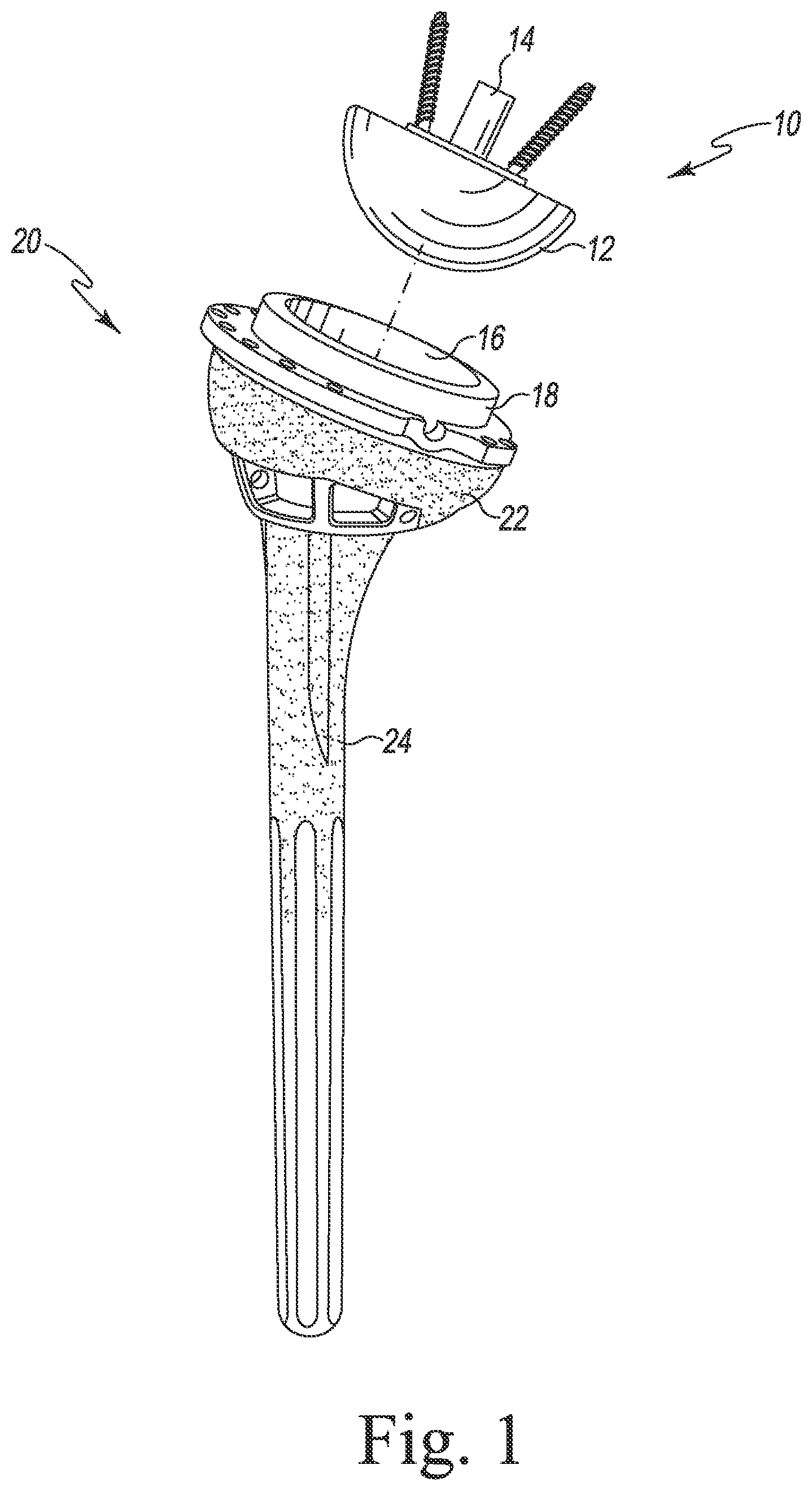 Patent US11771560 Figure 1 – Modular reverse shoulder orthopaedic implant and method of implanting the same