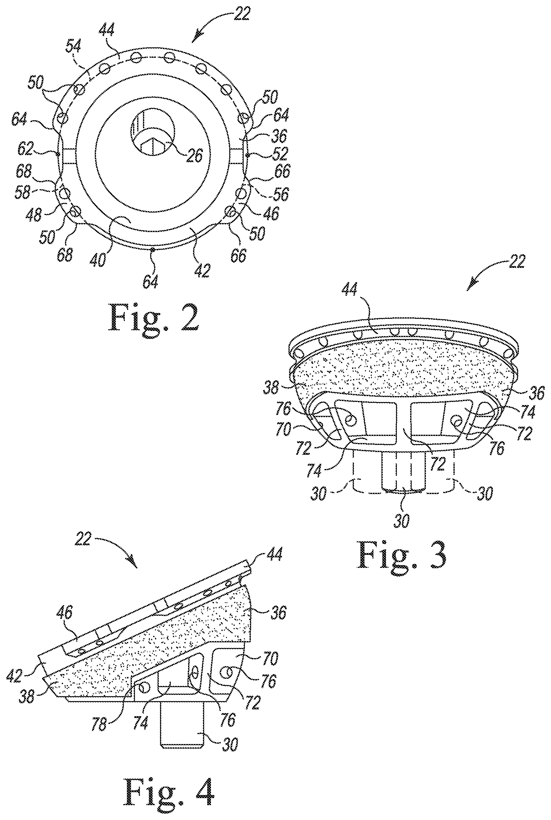 Patent US11771560 Figure 2 – Modular reverse shoulder orthopaedic implant and method of implanting the same
