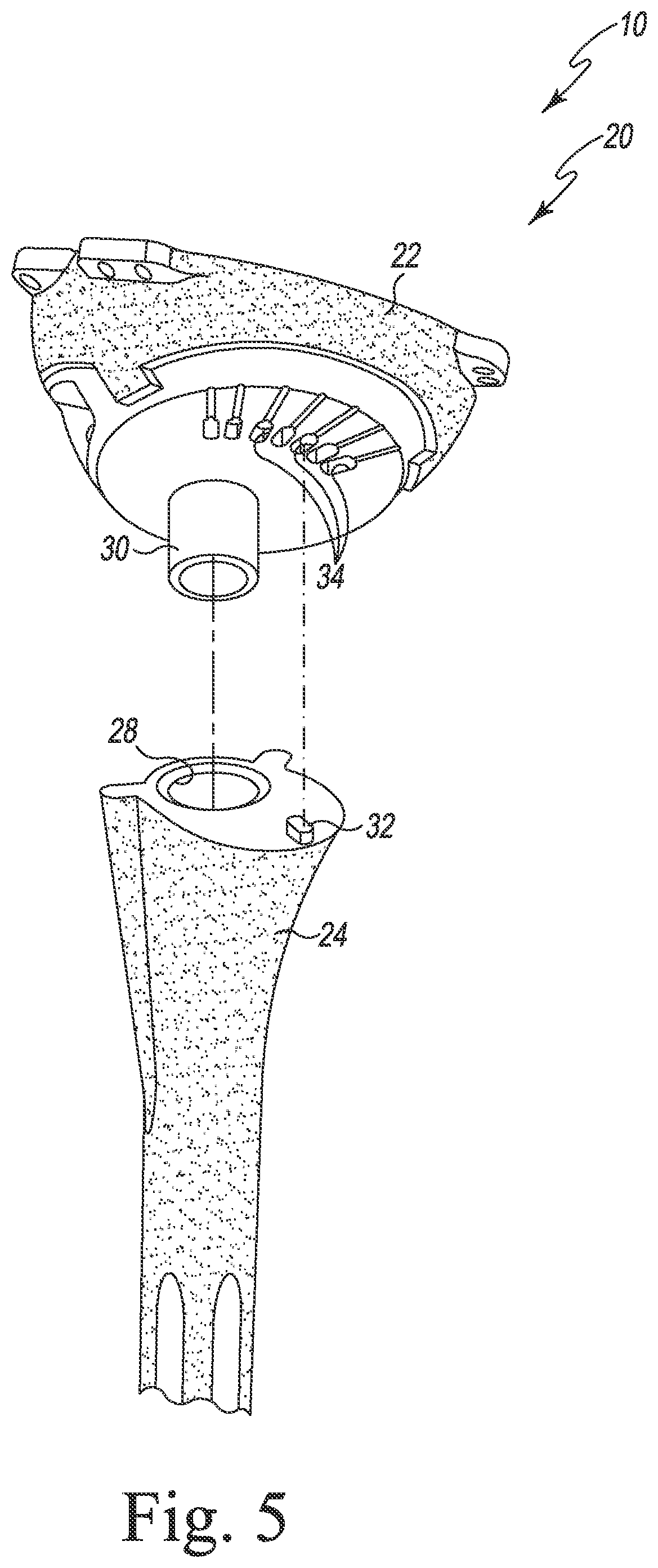 Patent US11771560 Figure 3 – Modular reverse shoulder orthopaedic implant and method of implanting the same