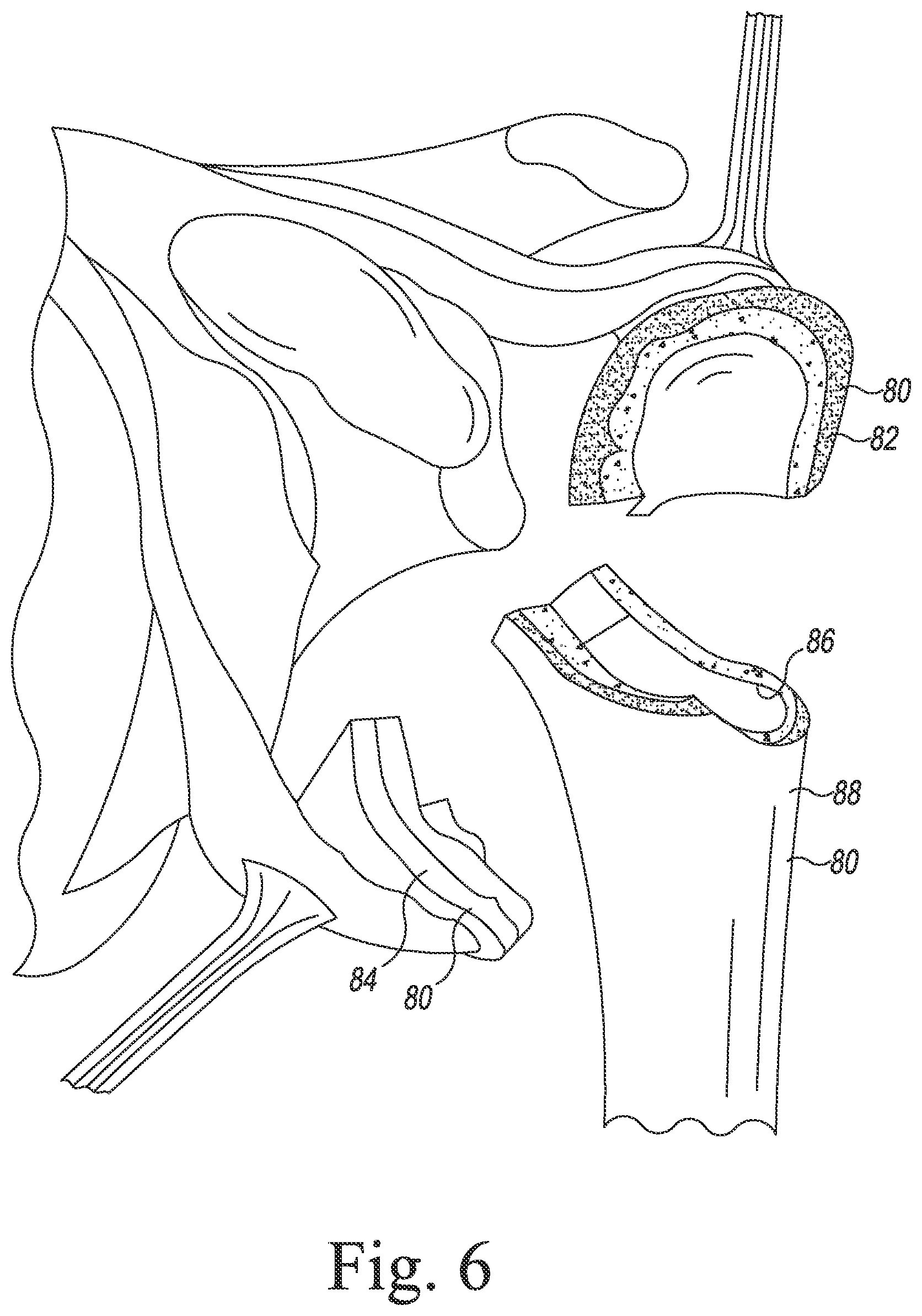 Patent US11771560 Figure 4 – Modular reverse shoulder orthopaedic implant and method of implanting the same
