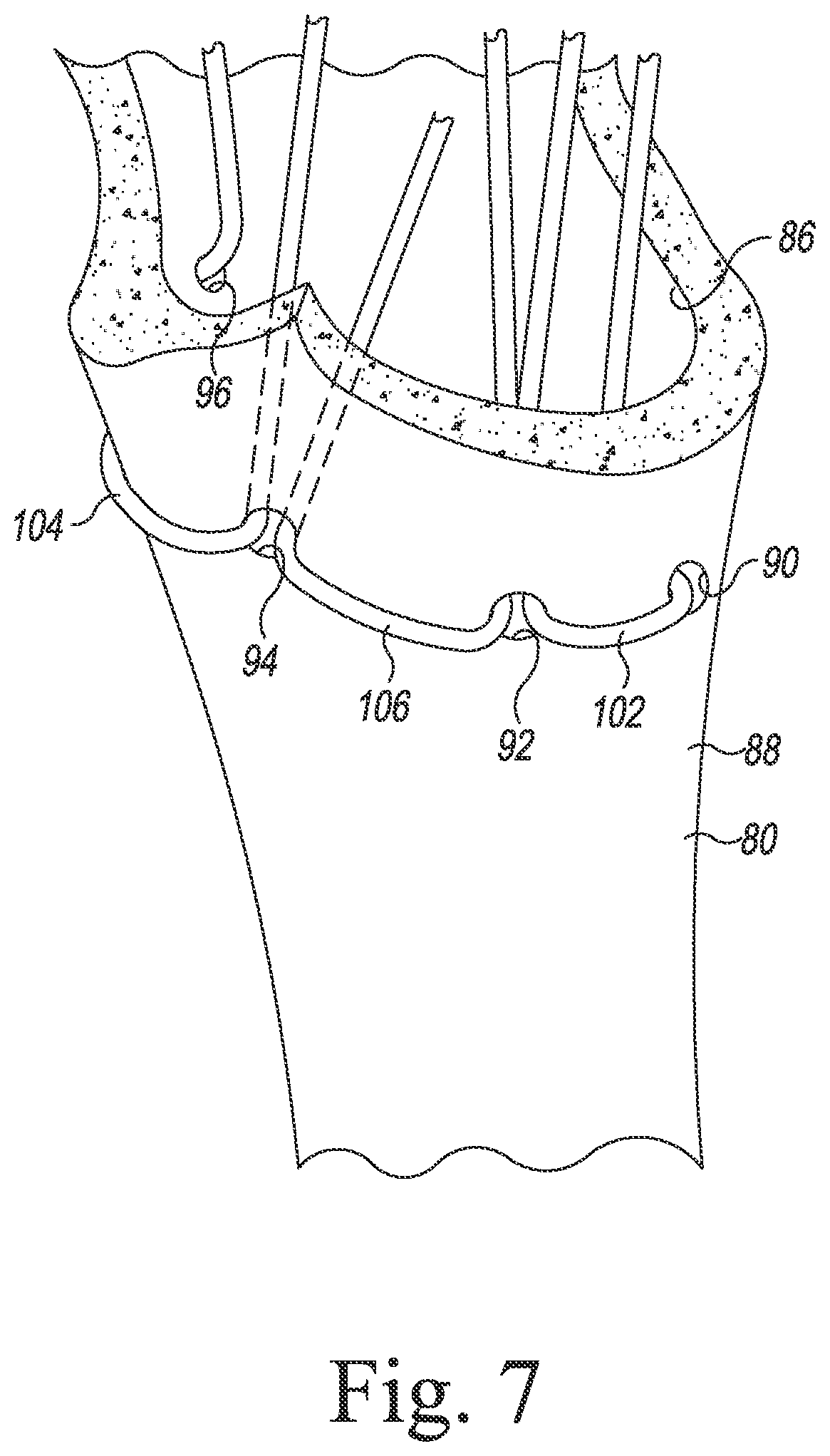 Patent US11771560 Figure 5 – Modular reverse shoulder orthopaedic implant and method of implanting the same