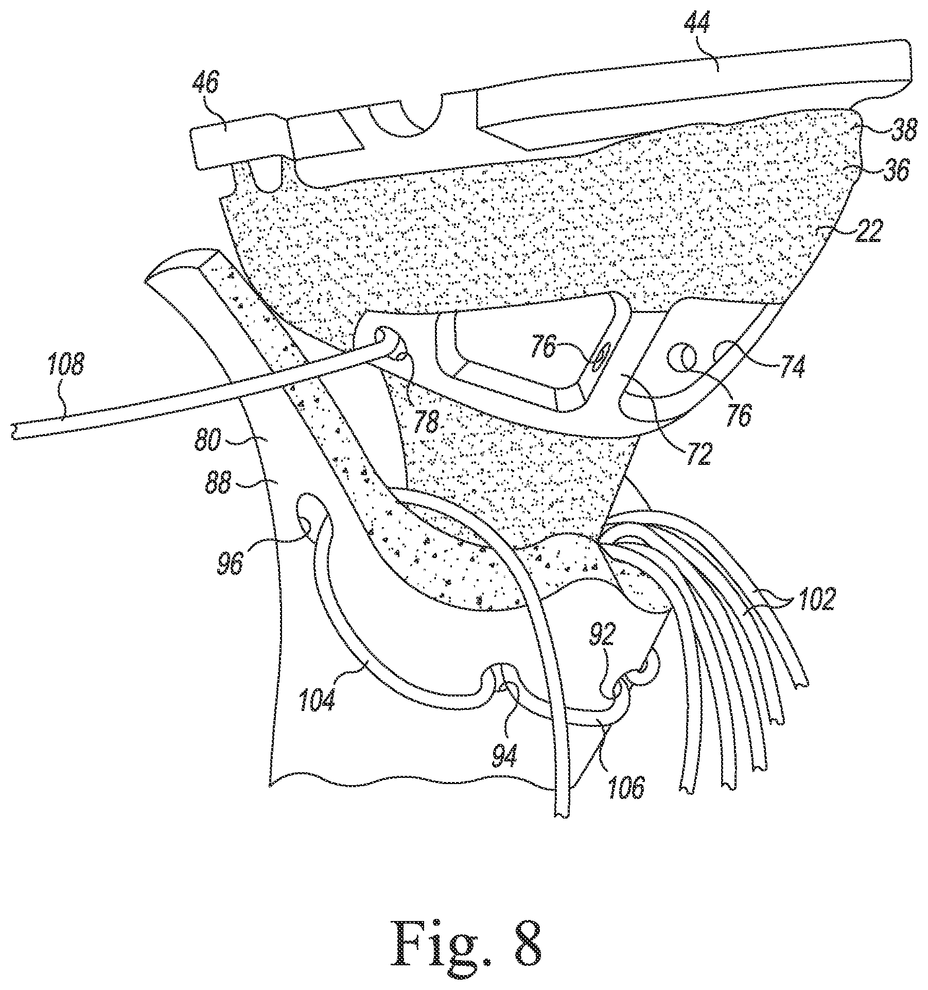 Patent US11771560 Figure 6 – Modular reverse shoulder orthopaedic implant and method of implanting the same