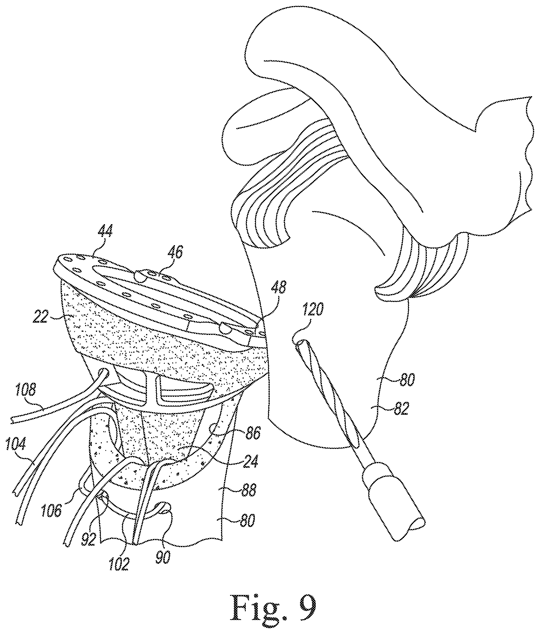 Patent US11771560 Figure 7 – Modular reverse shoulder orthopaedic implant and method of implanting the same