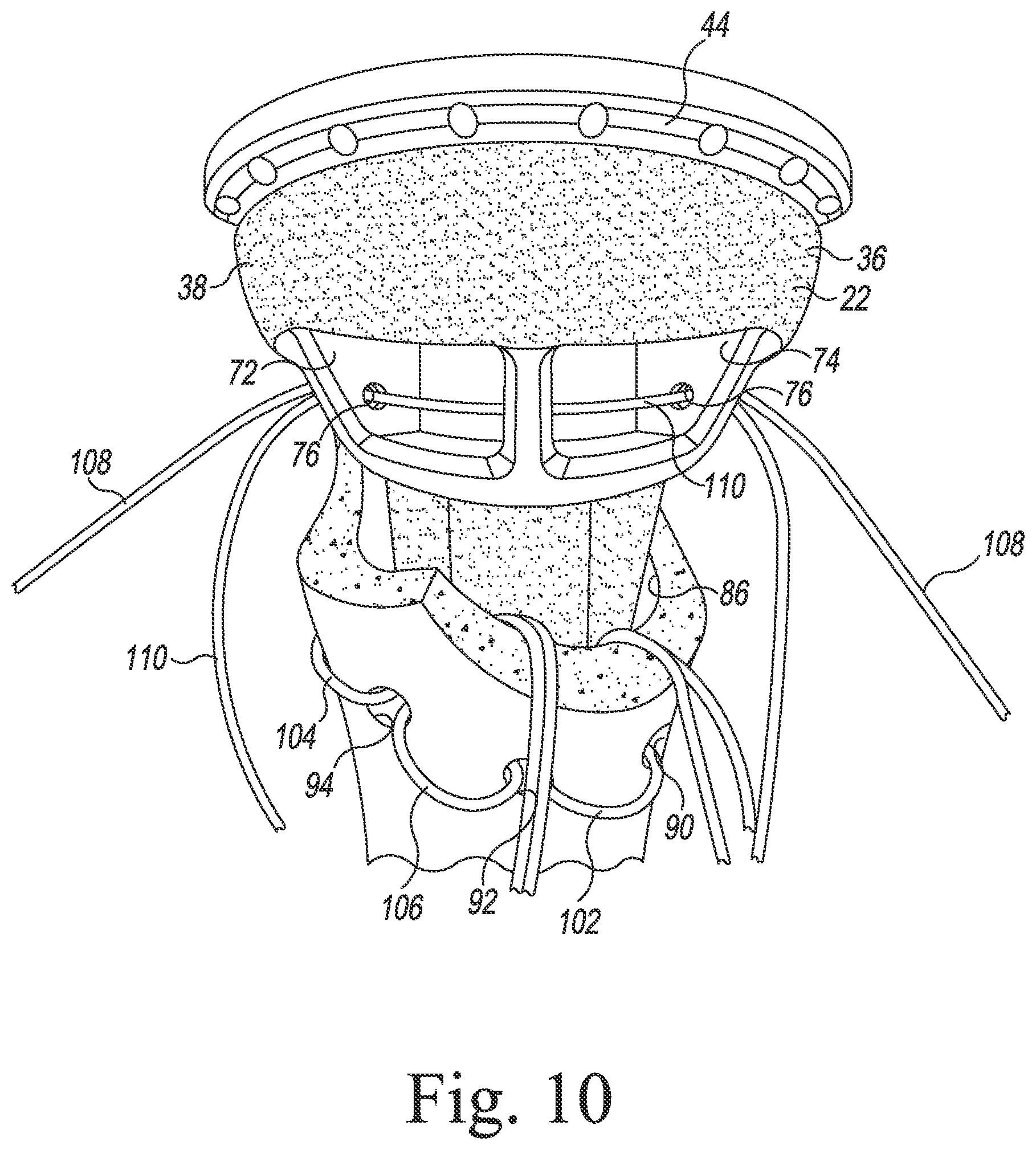 Patent US11771560 Figure 8 – Modular reverse shoulder orthopaedic implant and method of implanting the same