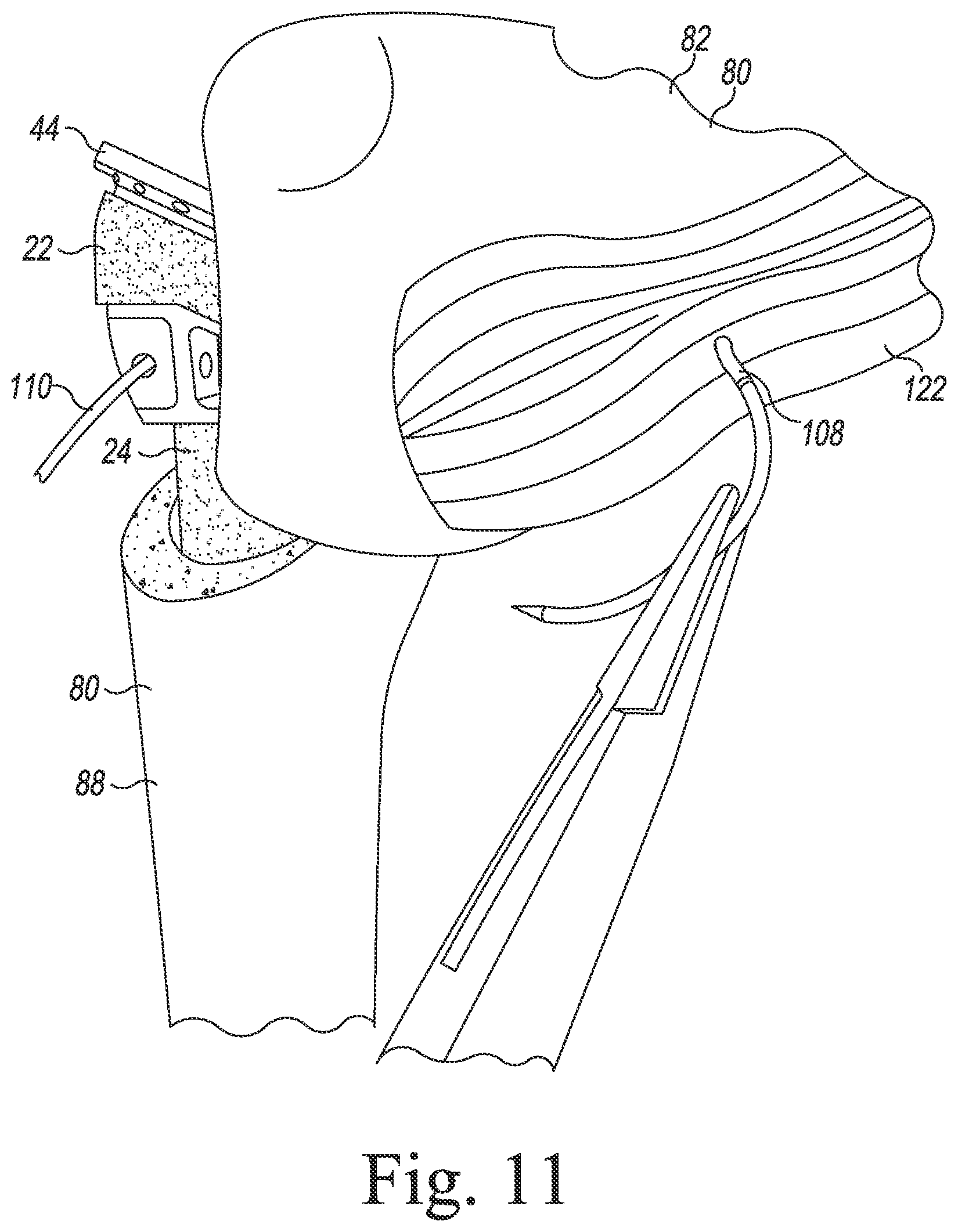 Patent US11771560 Figure 9 – Modular reverse shoulder orthopaedic implant and method of implanting the same