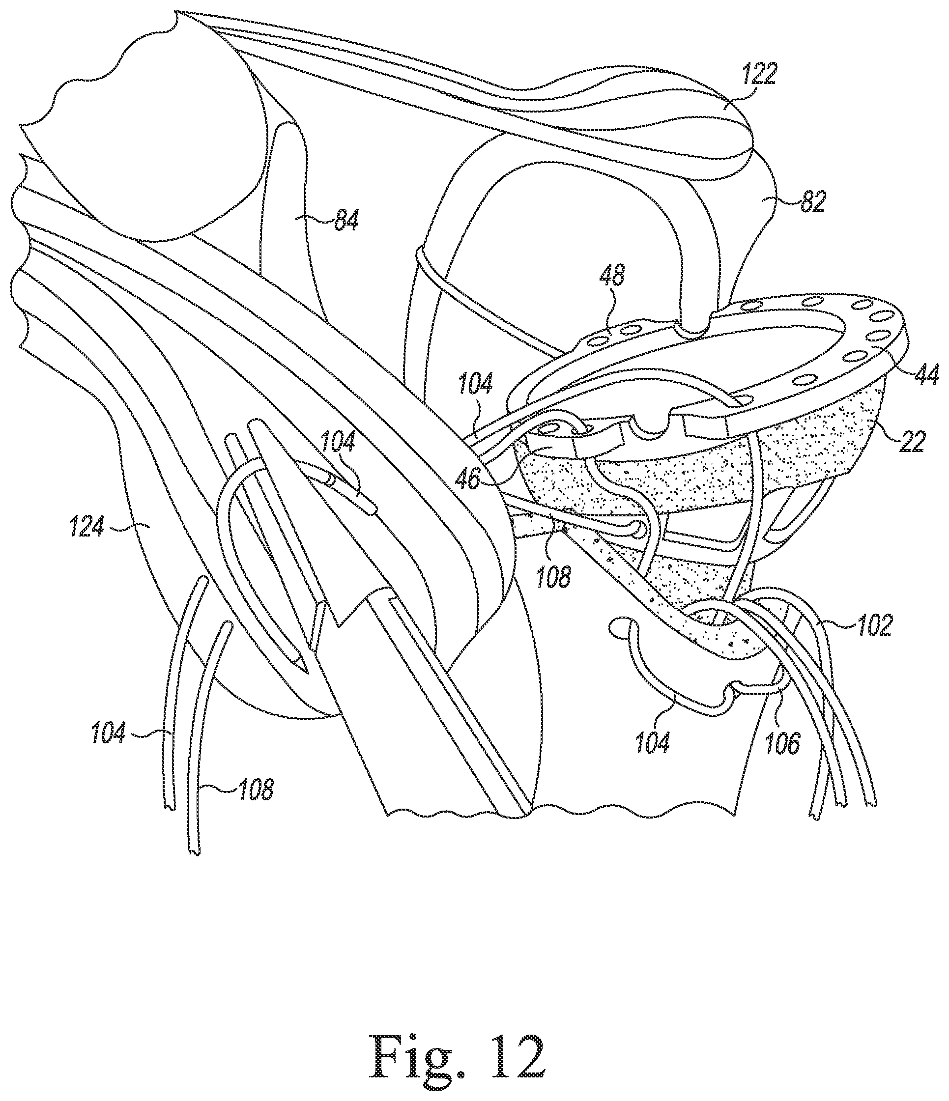 Patent US11771560 Figure 10 – Modular reverse shoulder orthopaedic implant and method of implanting the same