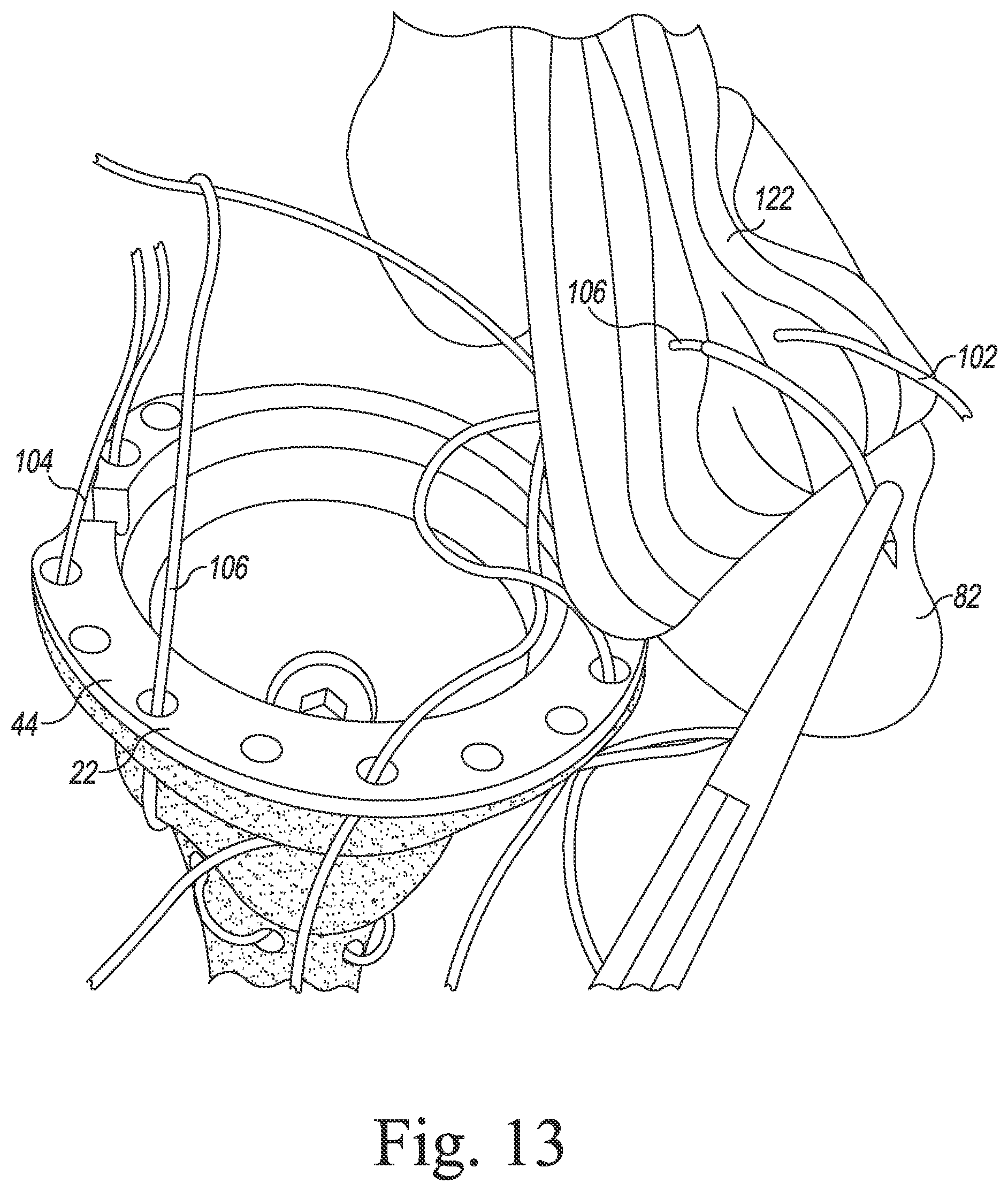 Patent US11771560 Figure 11 – Modular reverse shoulder orthopaedic implant and method of implanting the same