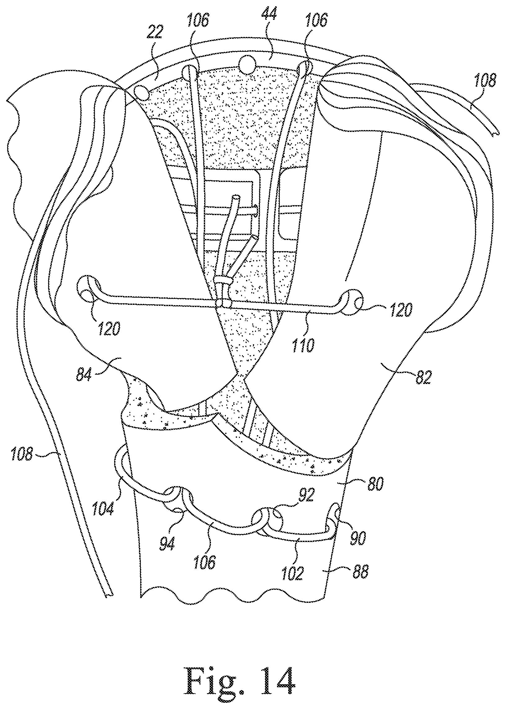 Patent US11771560 Figure 12 – Modular reverse shoulder orthopaedic implant and method of implanting the same