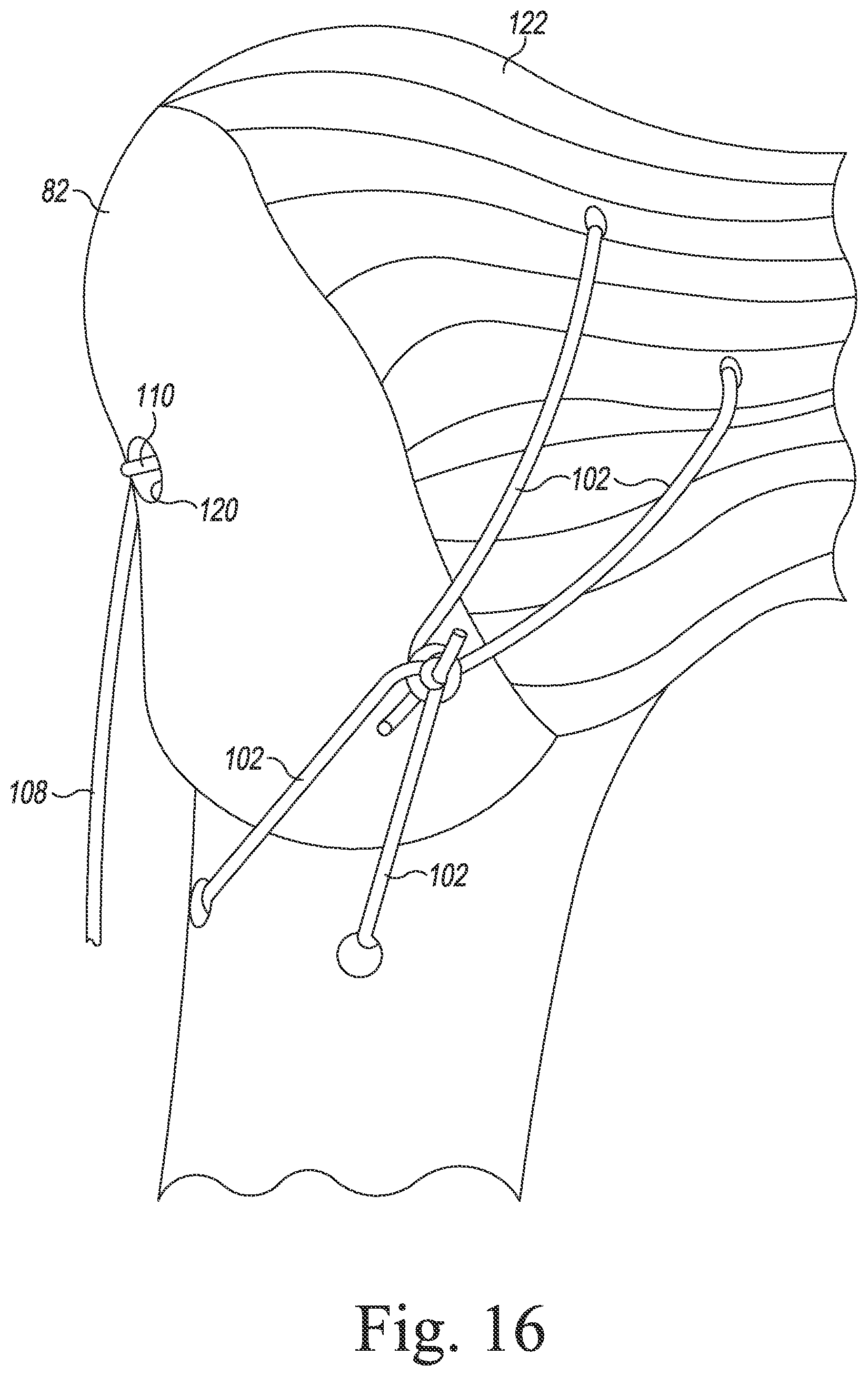Patent US11771560 Figure 14 – Modular reverse shoulder orthopaedic implant and method of implanting the same