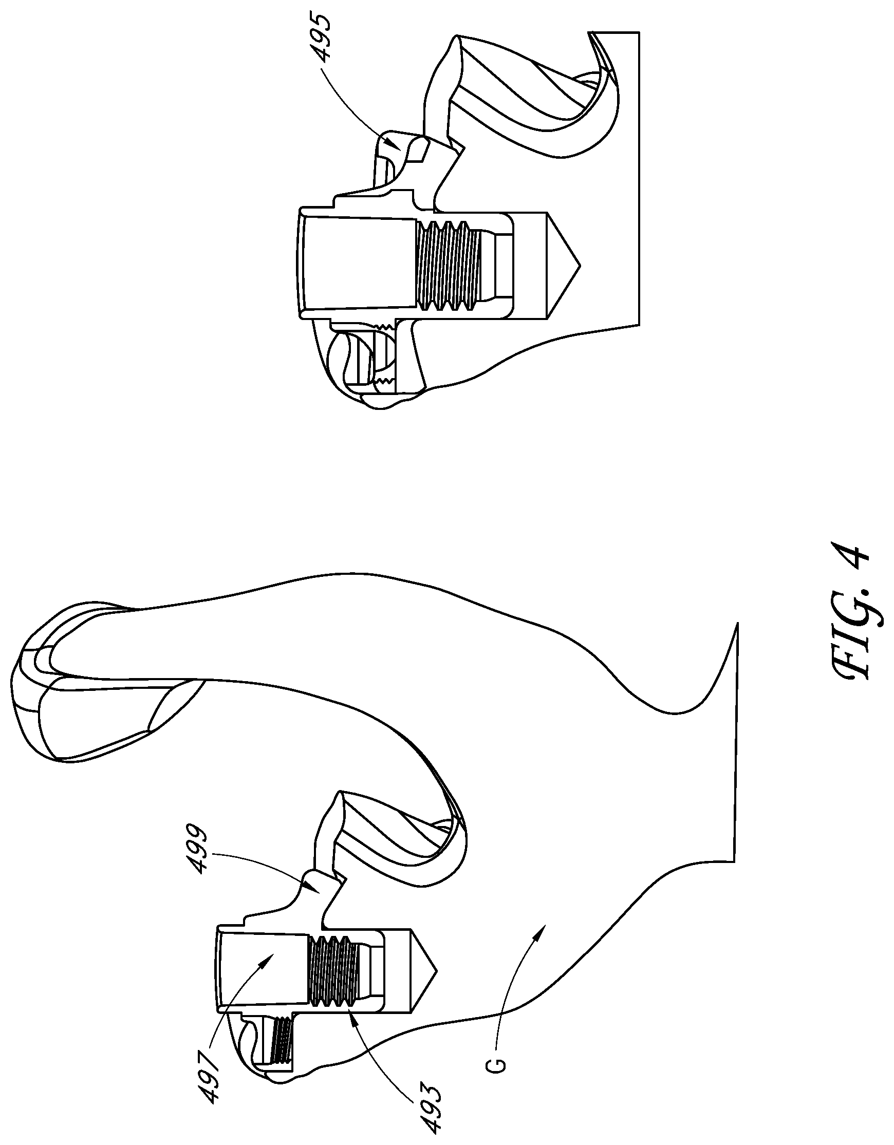 Patent US11771561 Figure 4 – Total reverse shoulder systems and methods