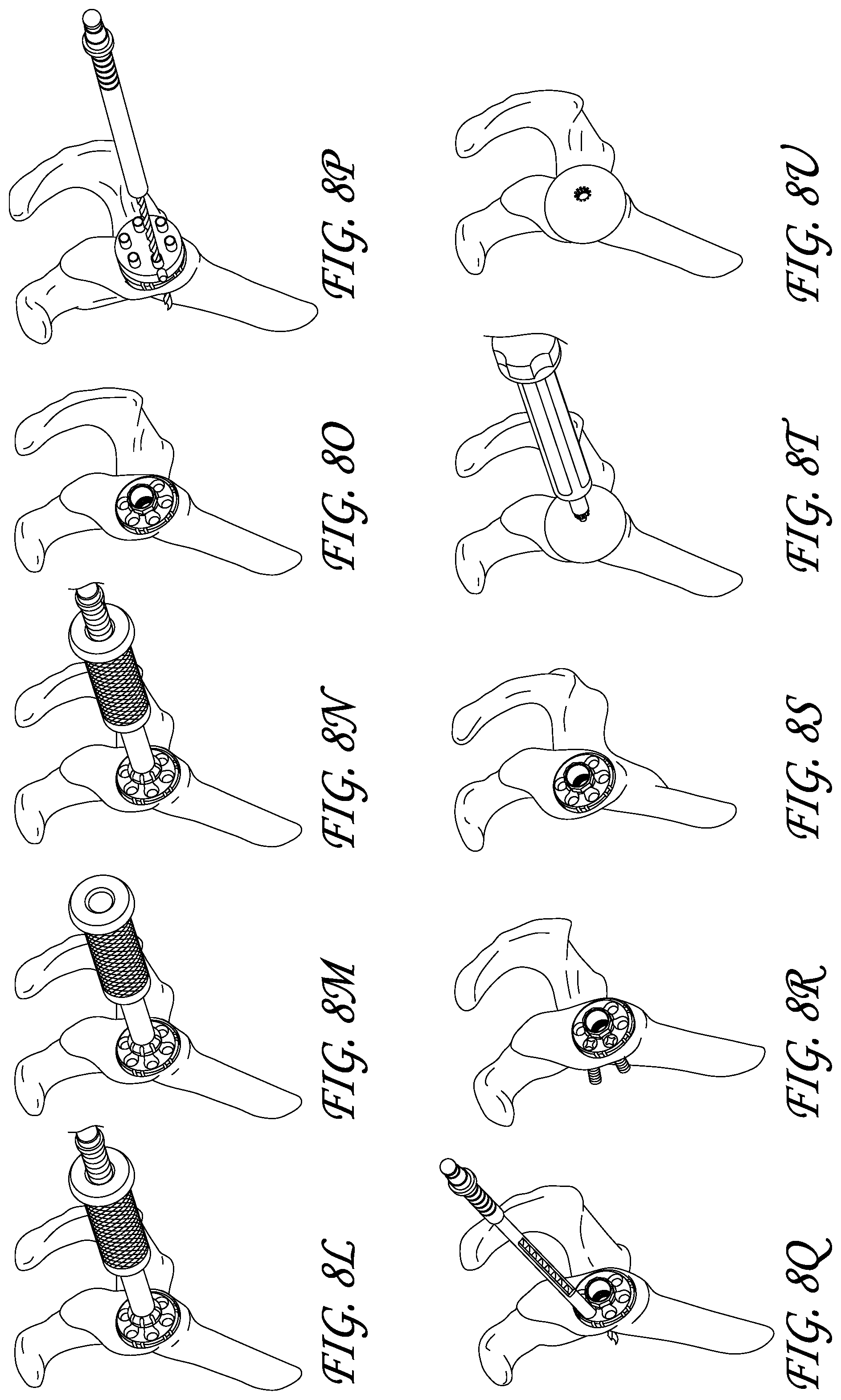 Patent US11771561 Figure 10 – Total reverse shoulder systems and methods