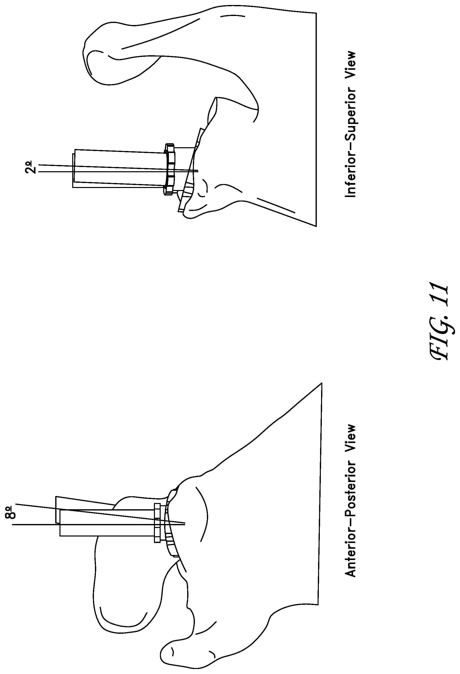 Patent US11771561 Figure 13 – Total reverse shoulder systems and methods