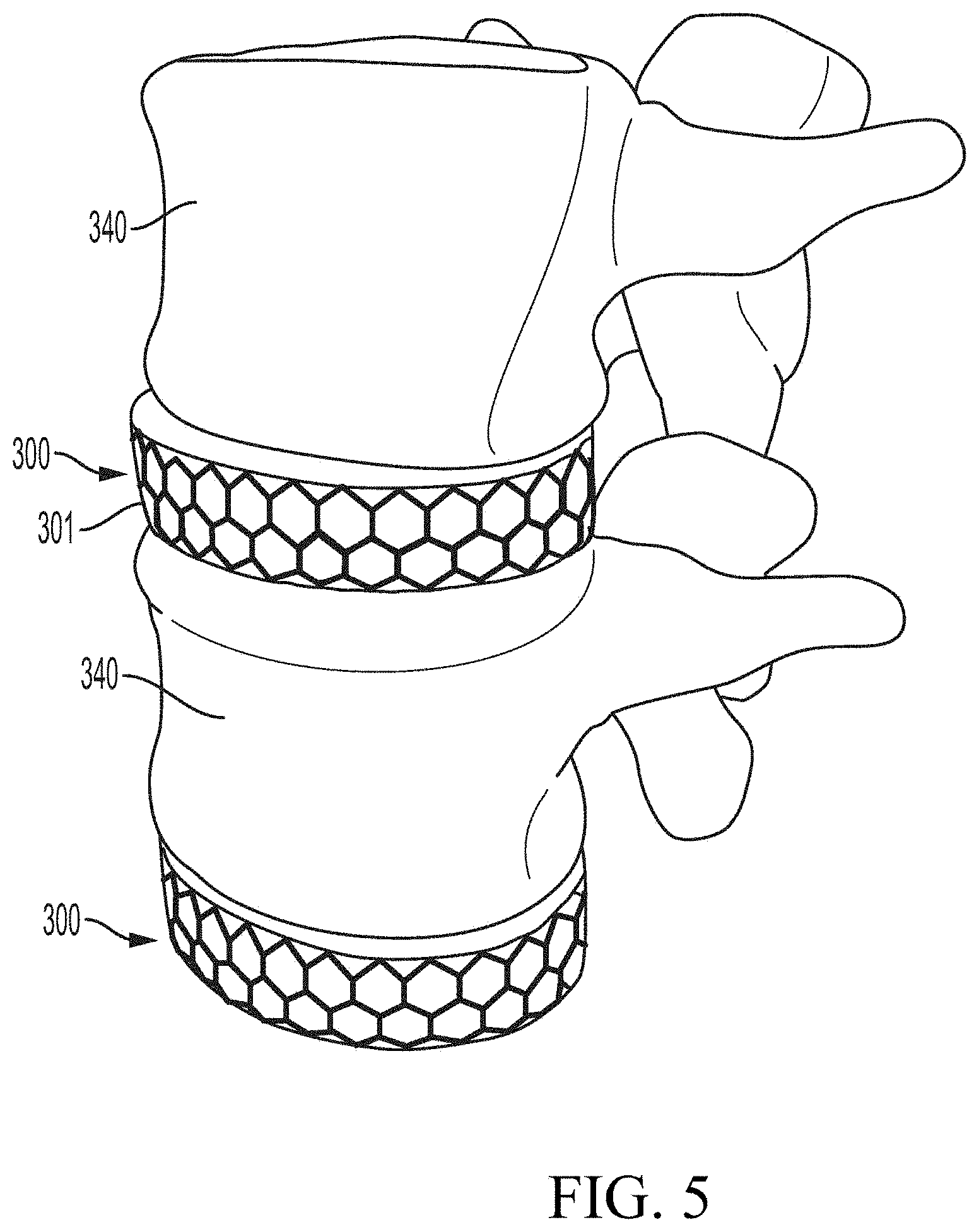 Patent US11771563 Figure 8 – Artificial tessellated implants, and systems and methods of making and using same