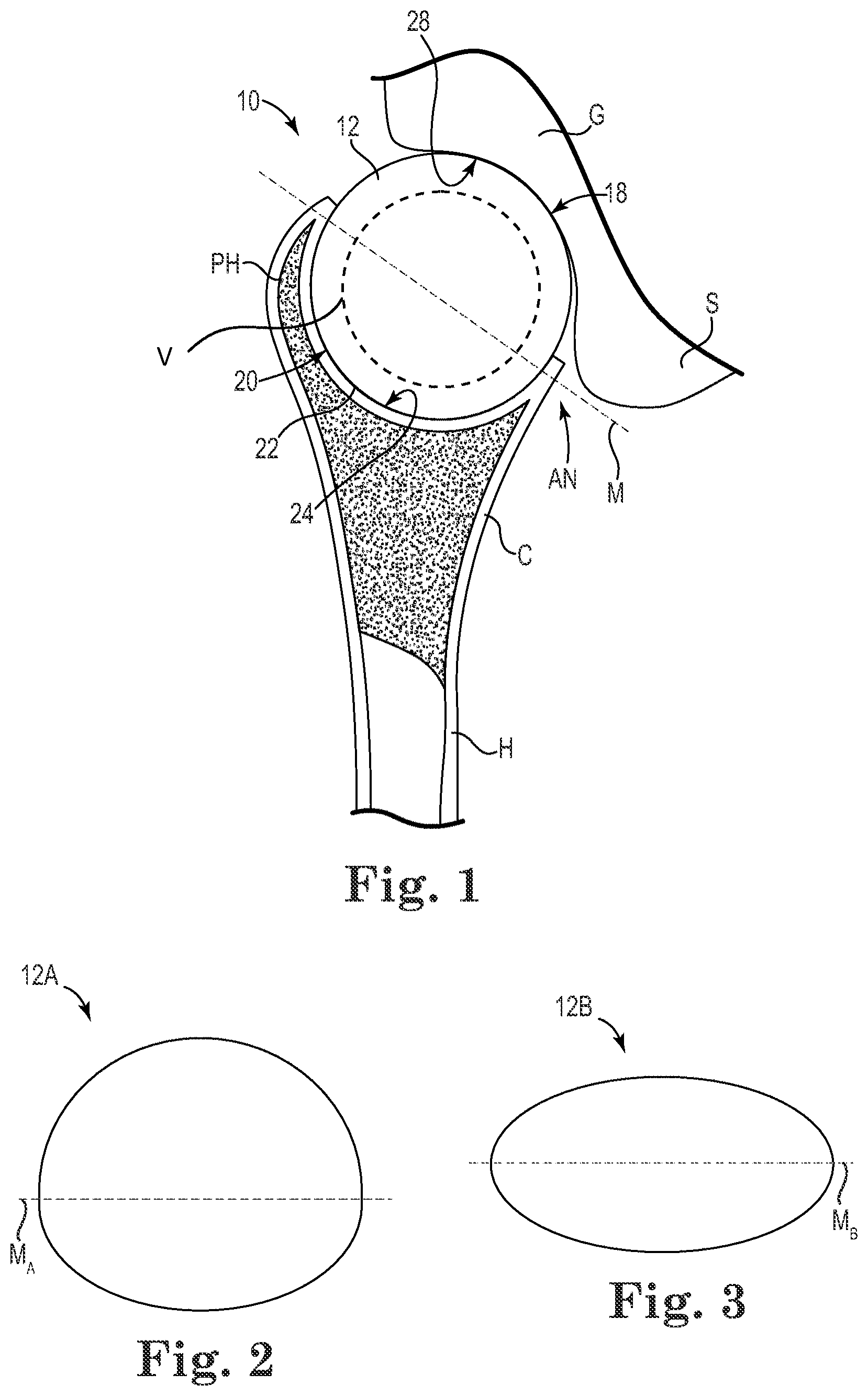 Patent US11771568 Figure 1 – Intra-articular joint replacement and method