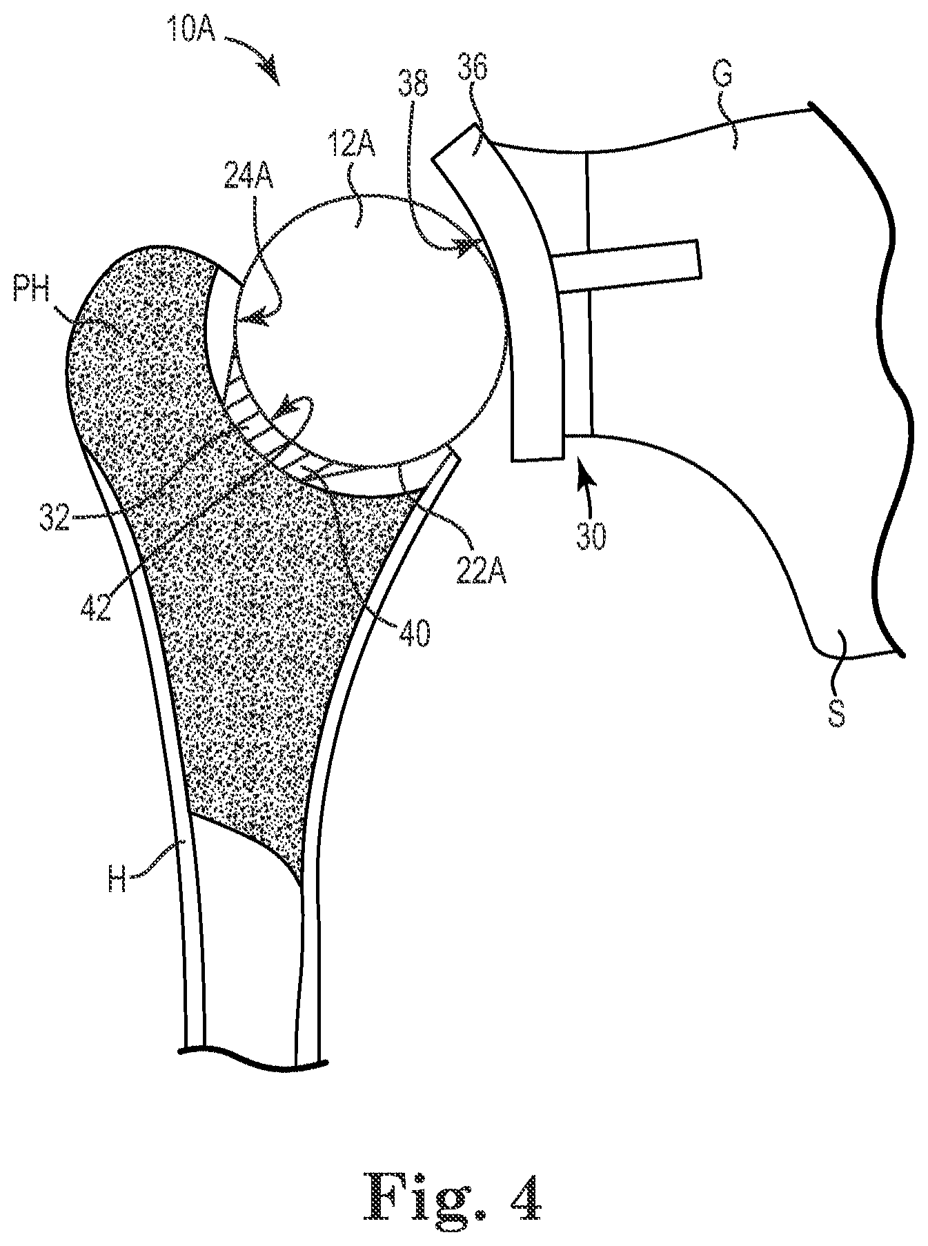 Patent US11771568 Figure 2 – Intra-articular joint replacement and method