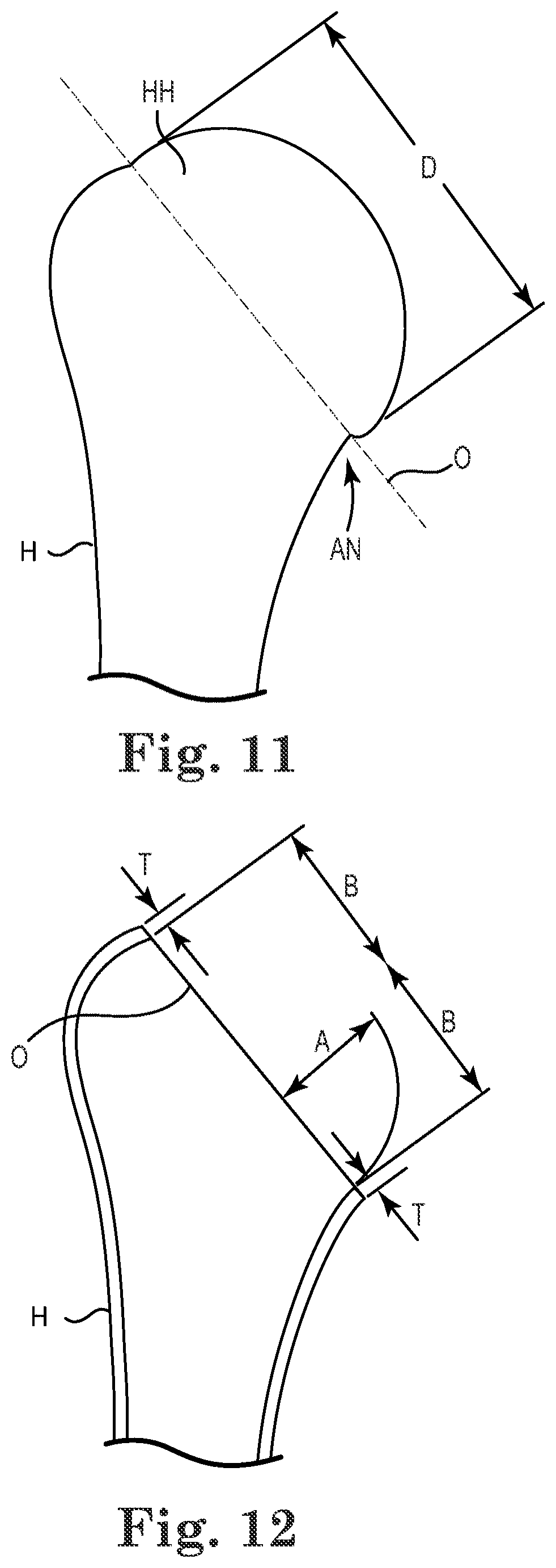 Patent US11771568 Figure 6 – Intra-articular joint replacement and method