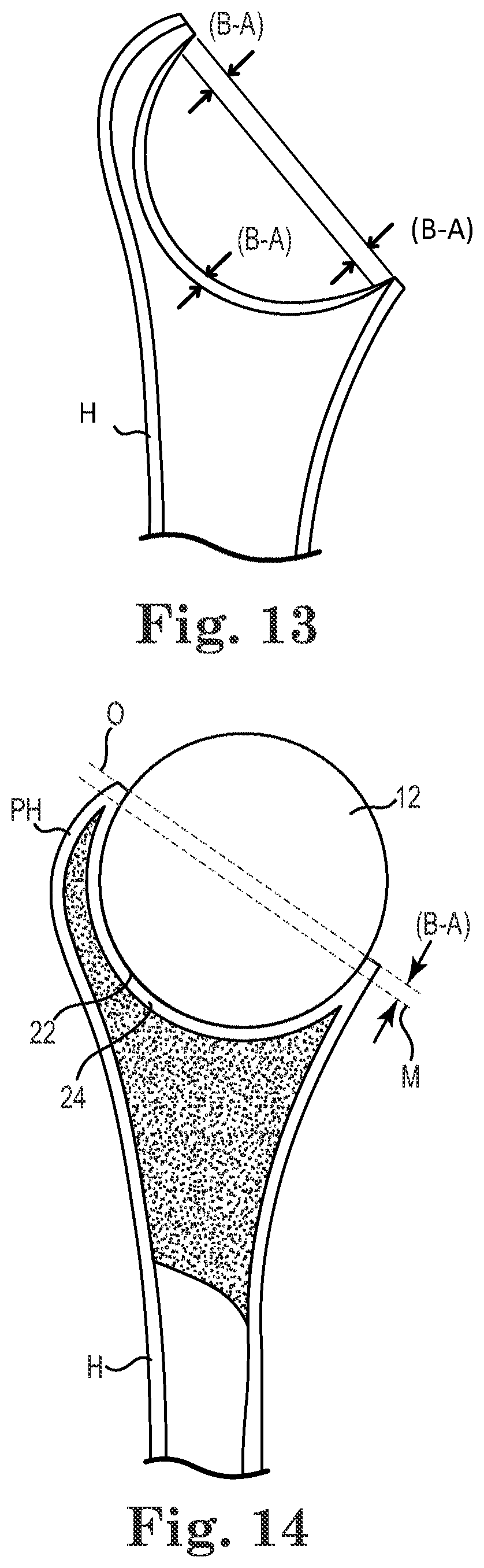 Patent US11771568 Figure 7 – Intra-articular joint replacement and method