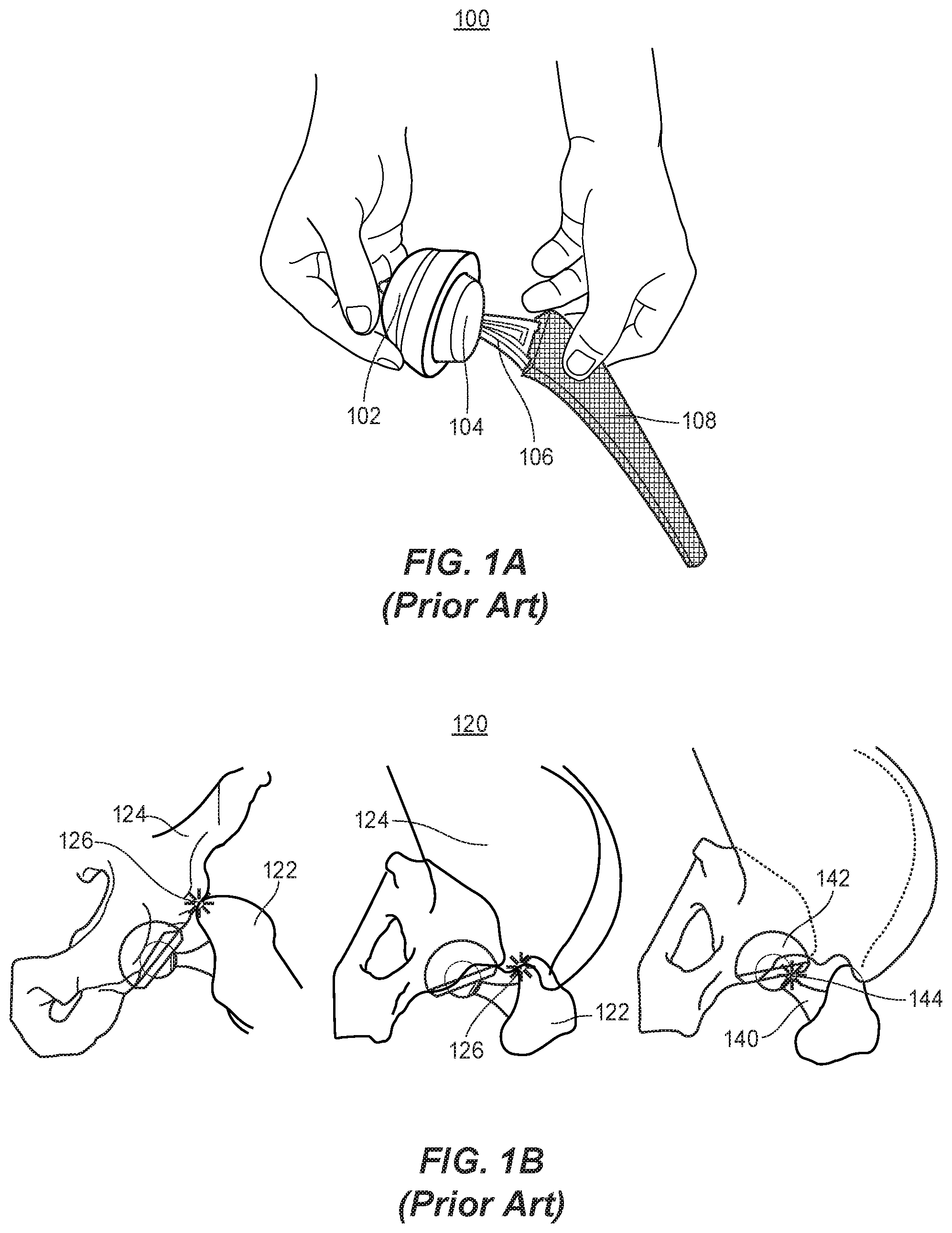 Patent US11771569 Figure 1 – System and method for aligning hip replacement prostheses