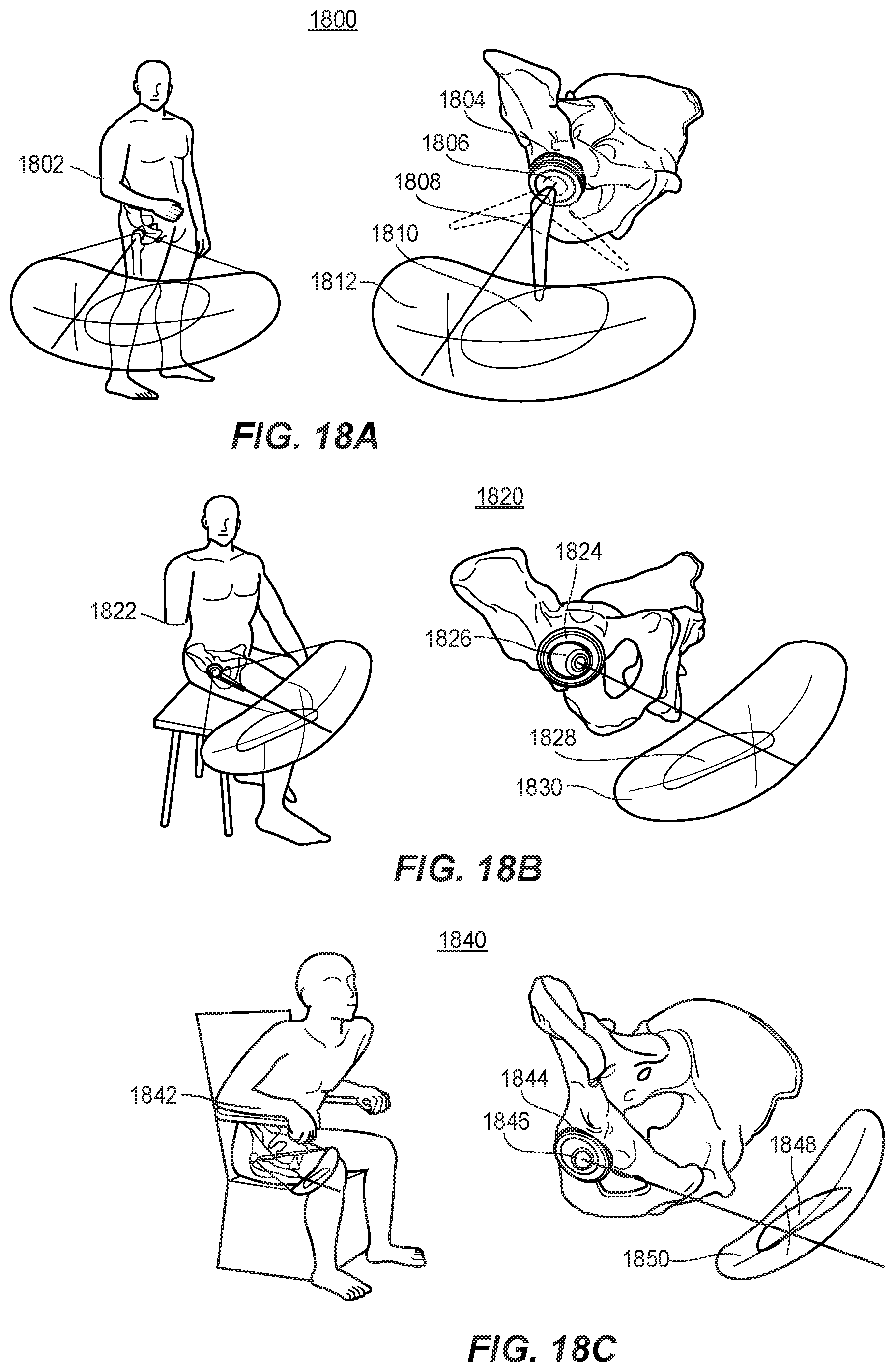 Patent US11771569 Figure 17 – System and method for aligning hip replacement prostheses