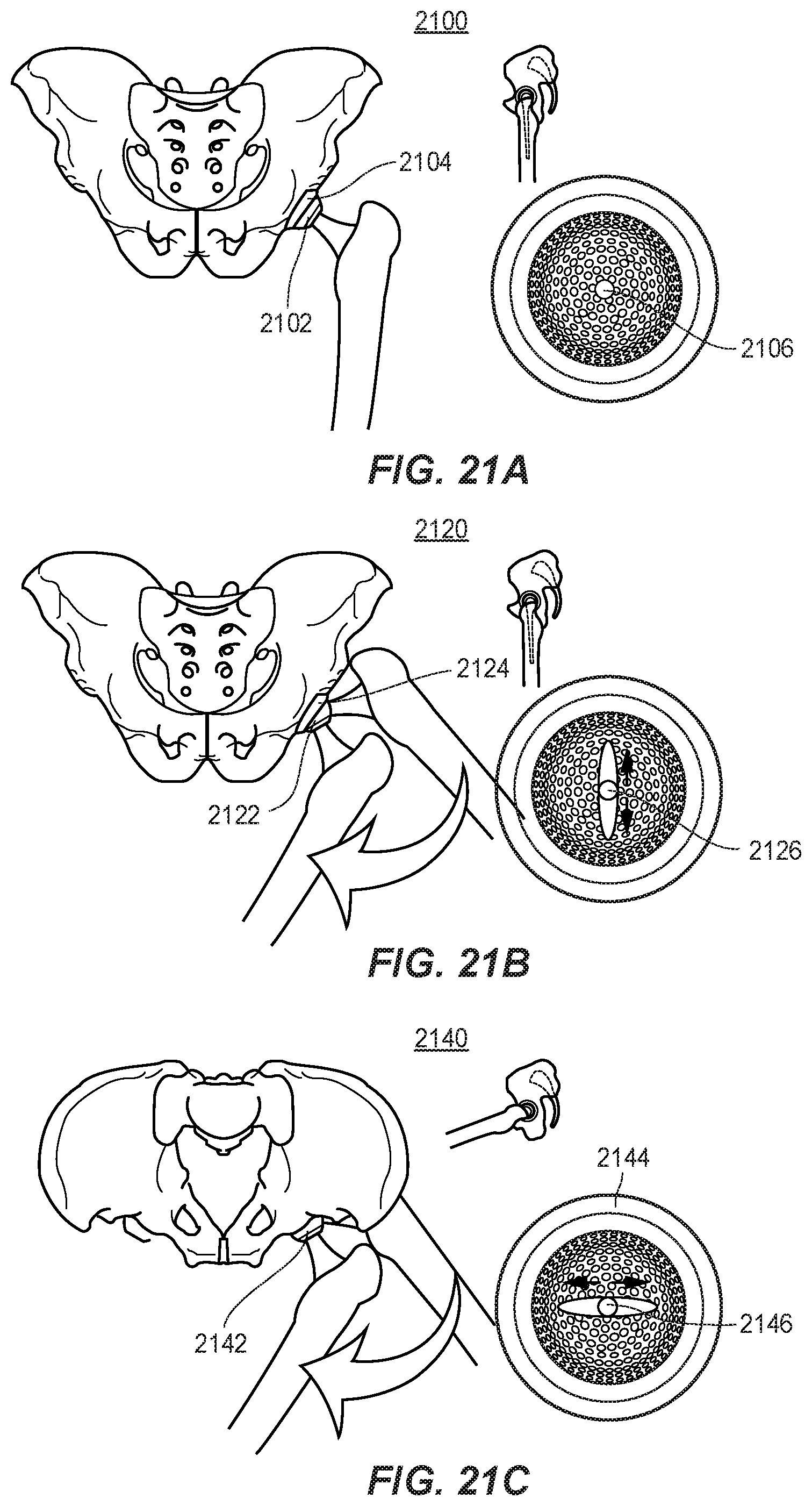 Patent US11771569 Figure 20 – System and method for aligning hip replacement prostheses