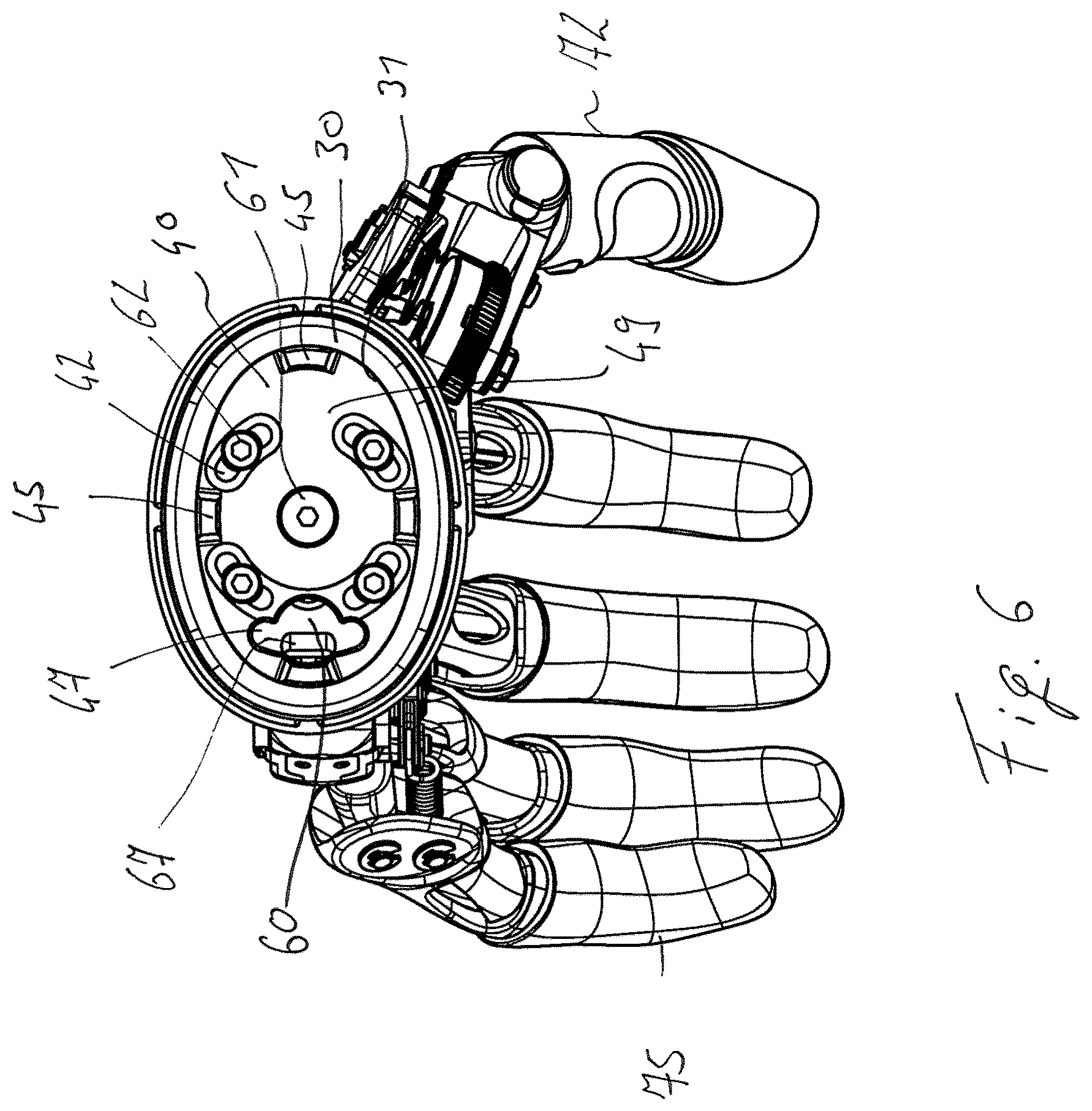 Patent US11771570 Figure 4 – Securing arrangement for a prosthetic hand on a forearm shaft and prosthesis system