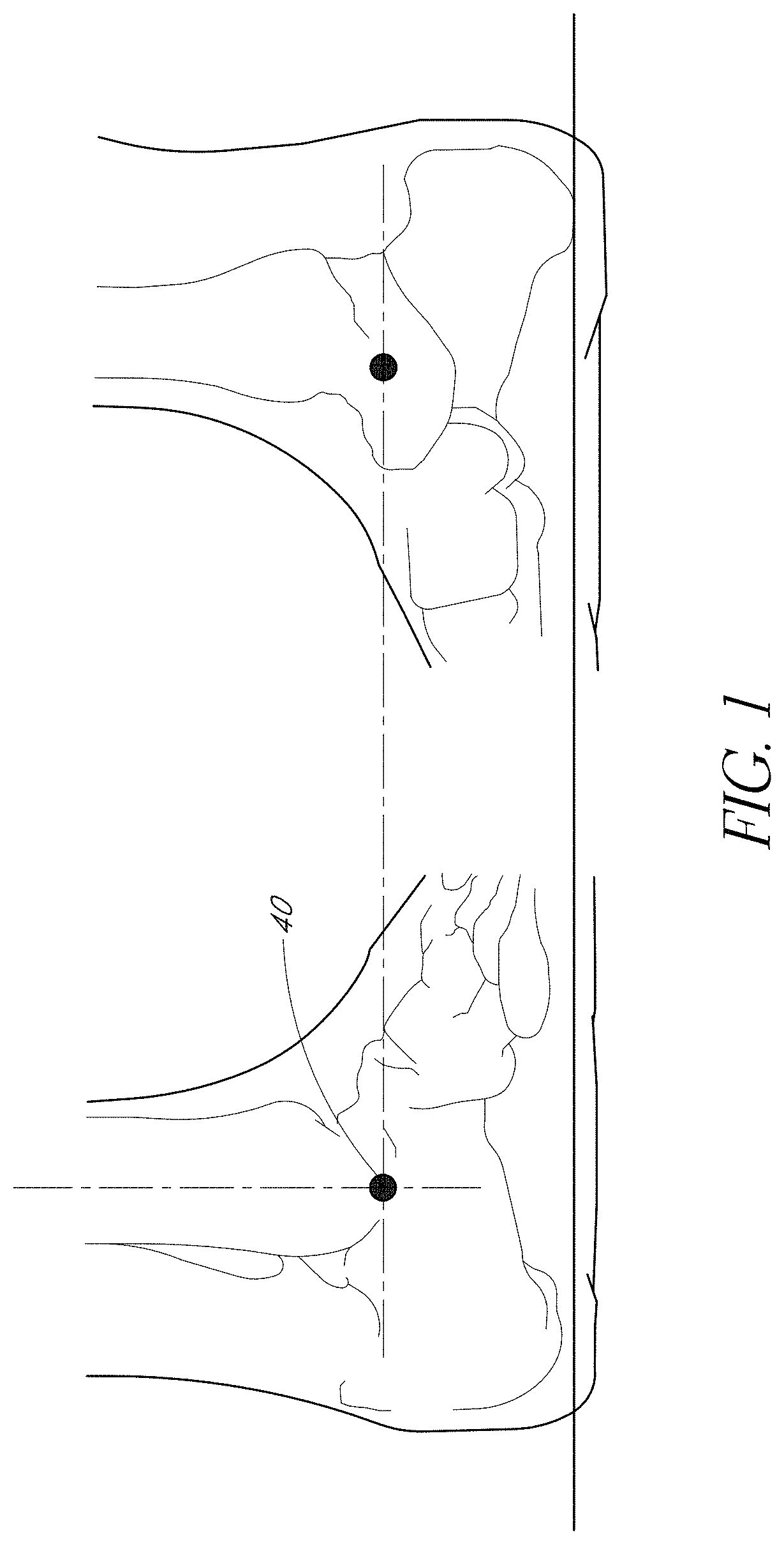 Patent US11771572 Figure 1 – Prosthetic feet having heel height adjustability