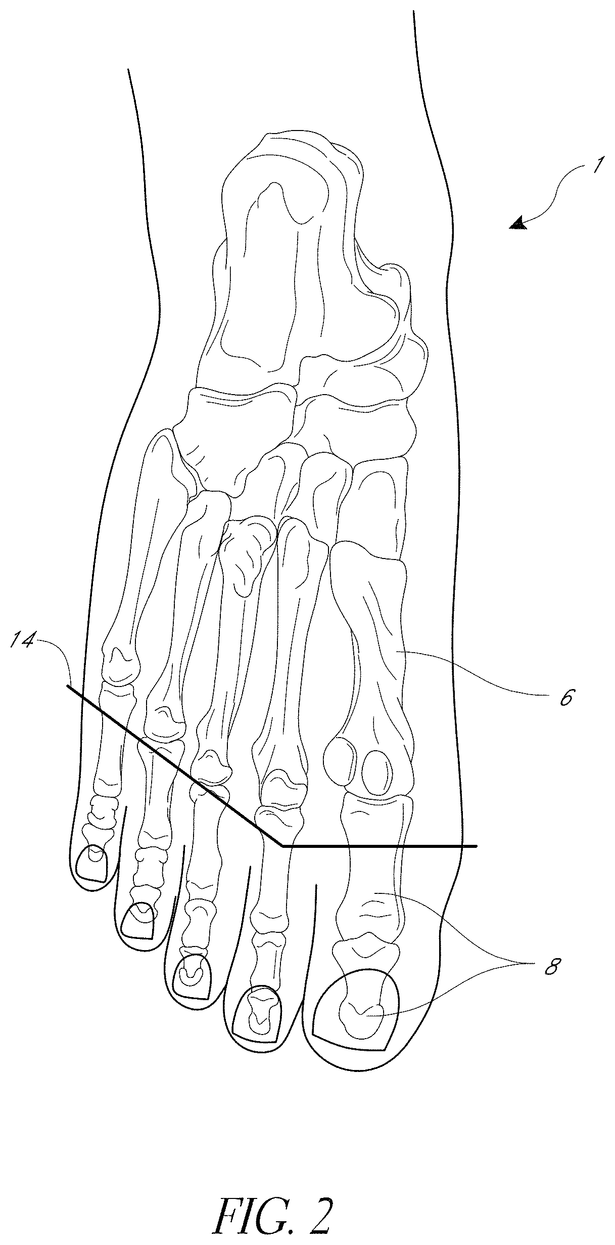 Patent US11771572 Figure 2 – Prosthetic feet having heel height adjustability