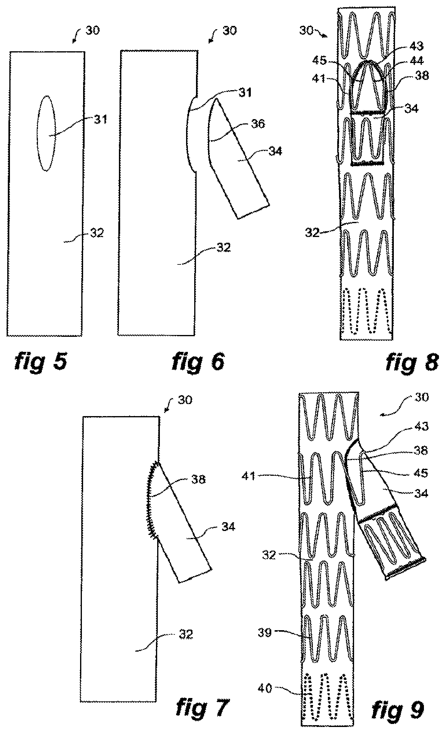 Patent US11771573 Figure 2 – Side branch stent graft