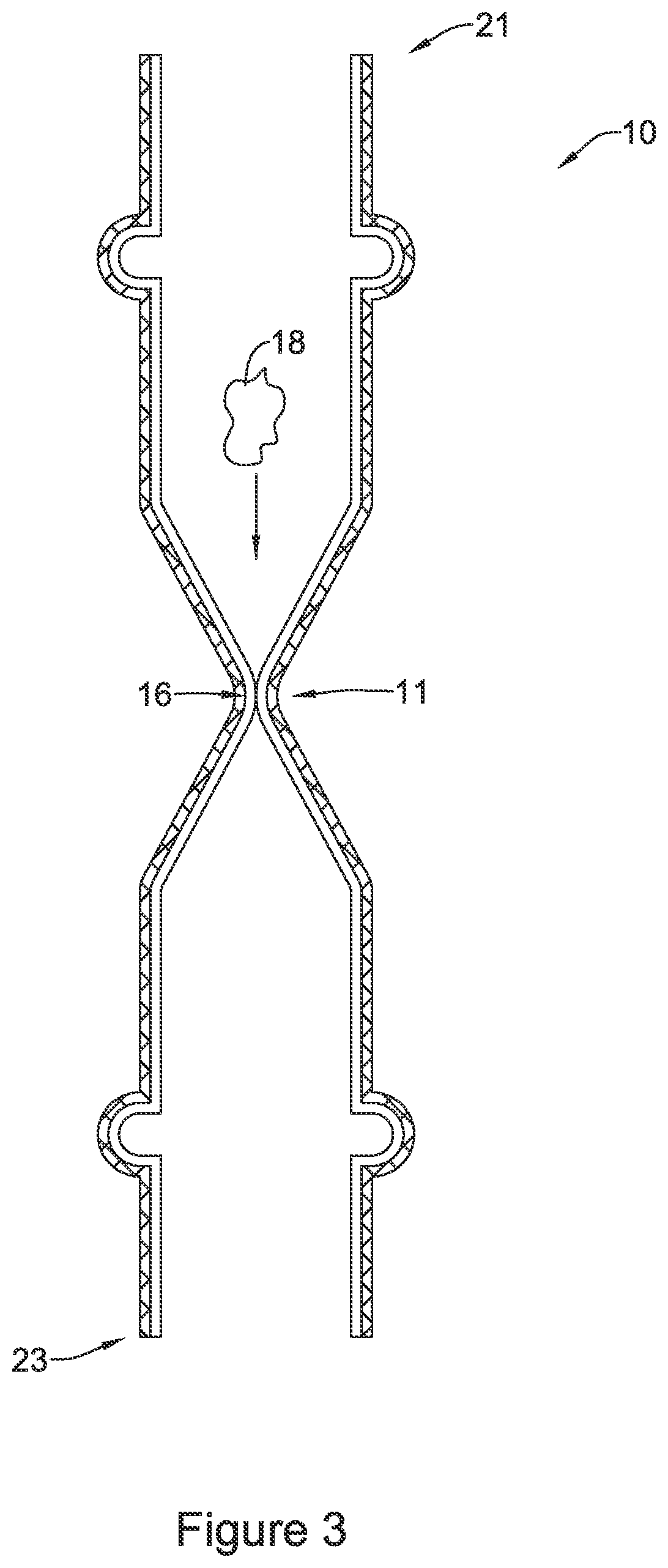 Patent US11771574 Figure 3 – Esophageal stent including a valve member