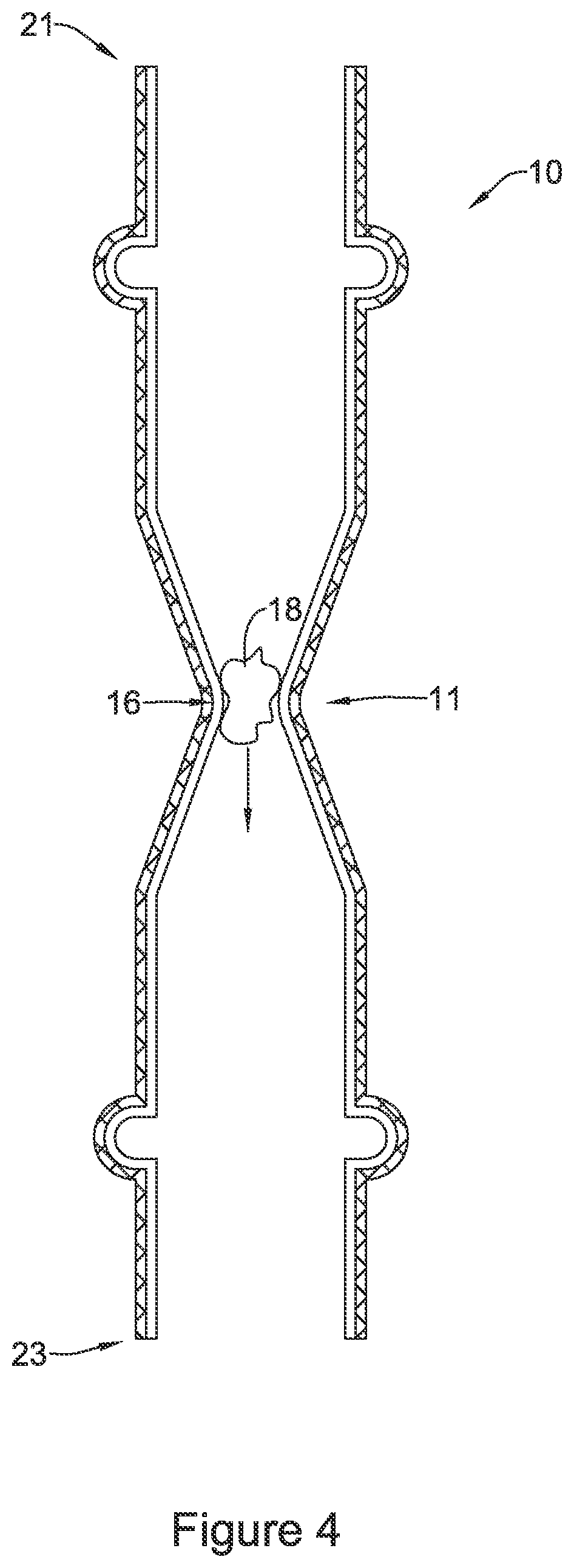 Patent US11771574 Figure 4 – Esophageal stent including a valve member