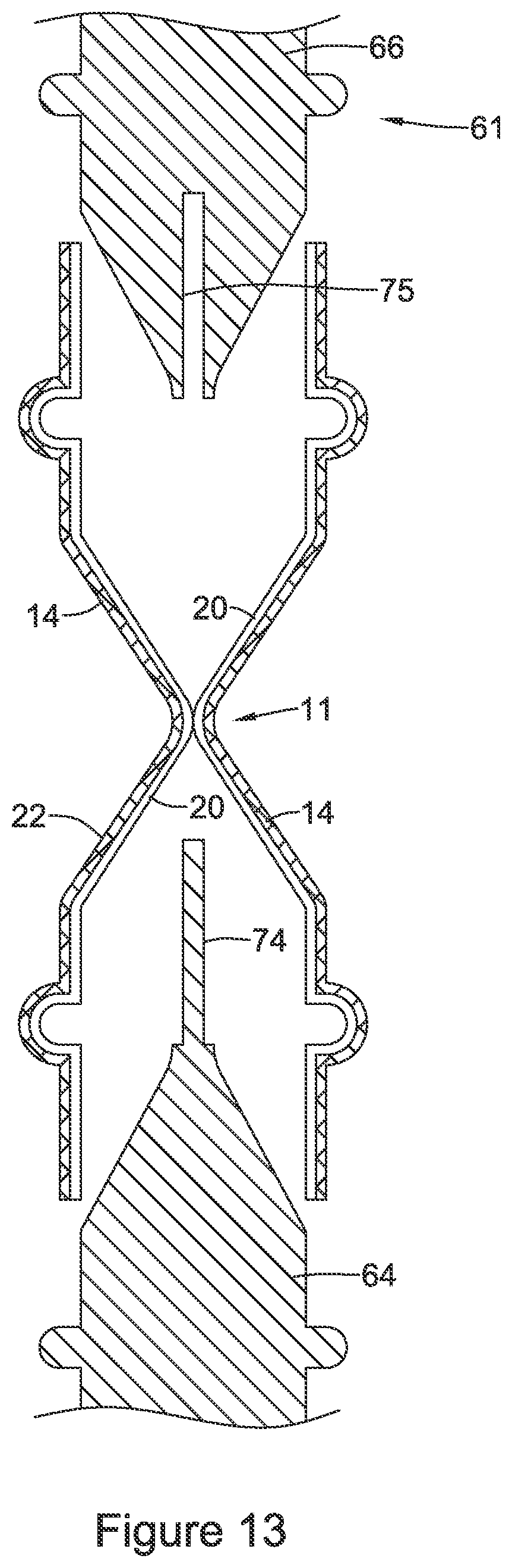 Patent US11771574 Figure 13 – Esophageal stent including a valve member