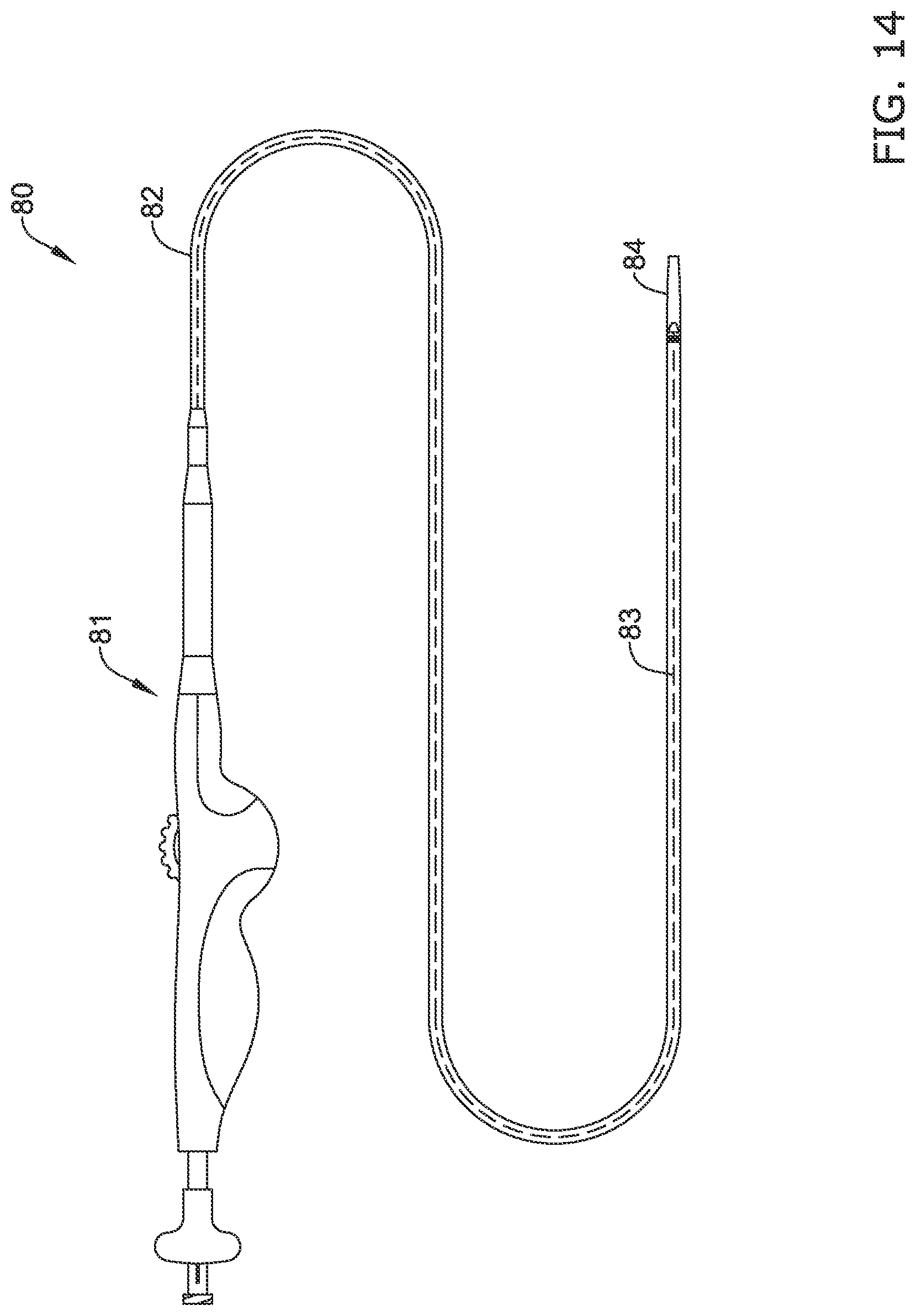 Patent US11771574 Figure 14 – Esophageal stent including a valve member
