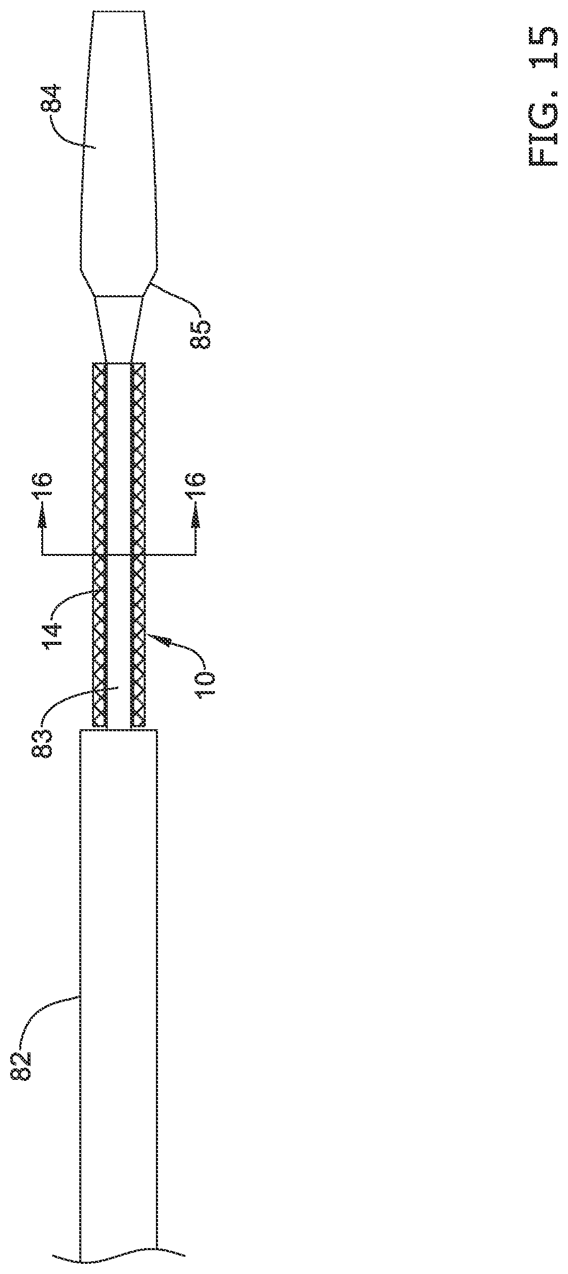 Patent US11771574 Figure 15 – Esophageal stent including a valve member