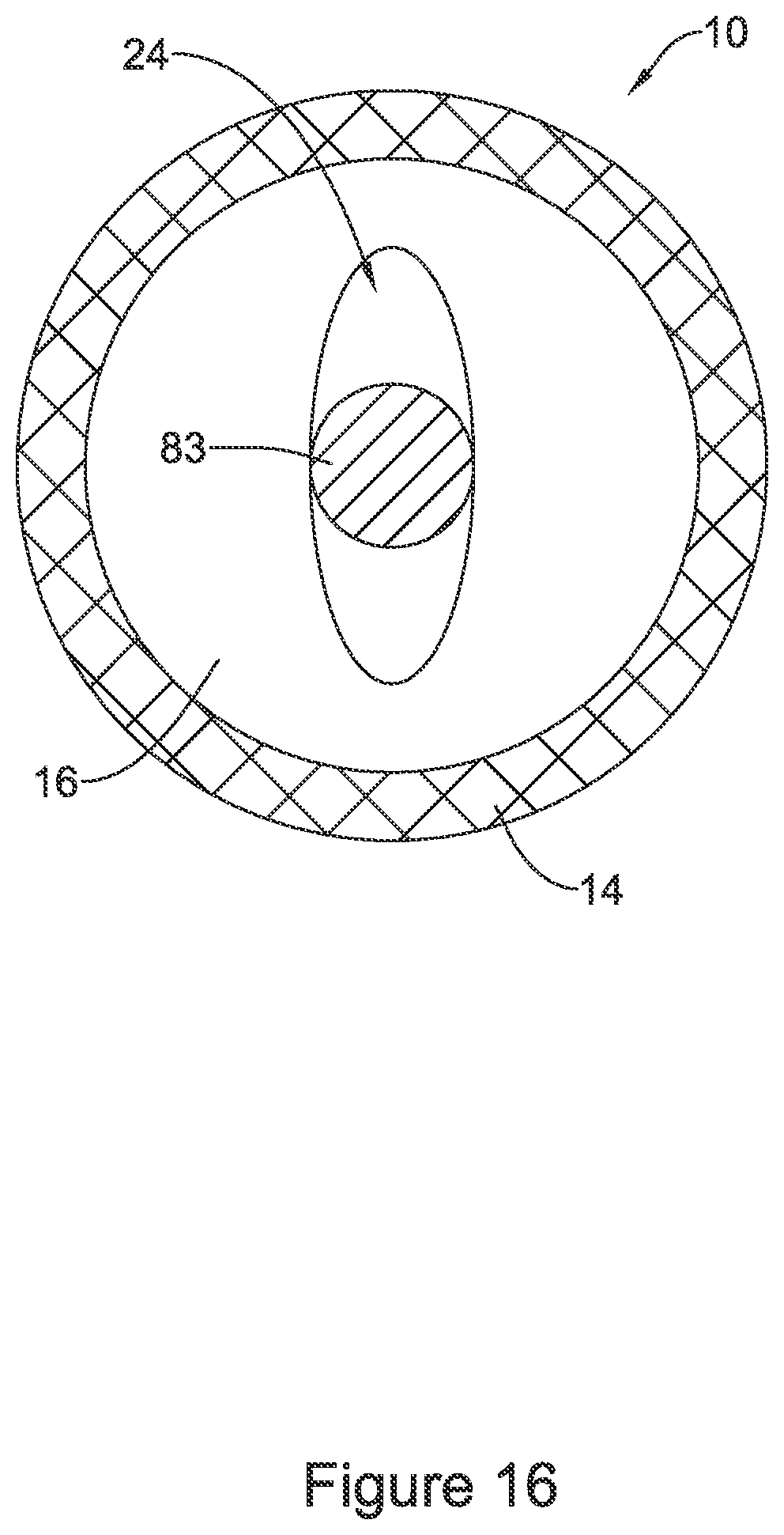 Patent US11771574 Figure 16 – Esophageal stent including a valve member