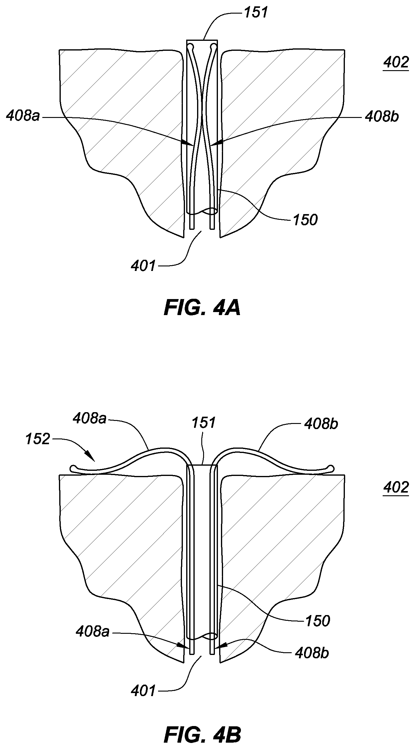 Patent US11771575 Figure 9 – Systems, devices, and methods for the accurate deployment and imaging of an implant in the prostatic urethra
