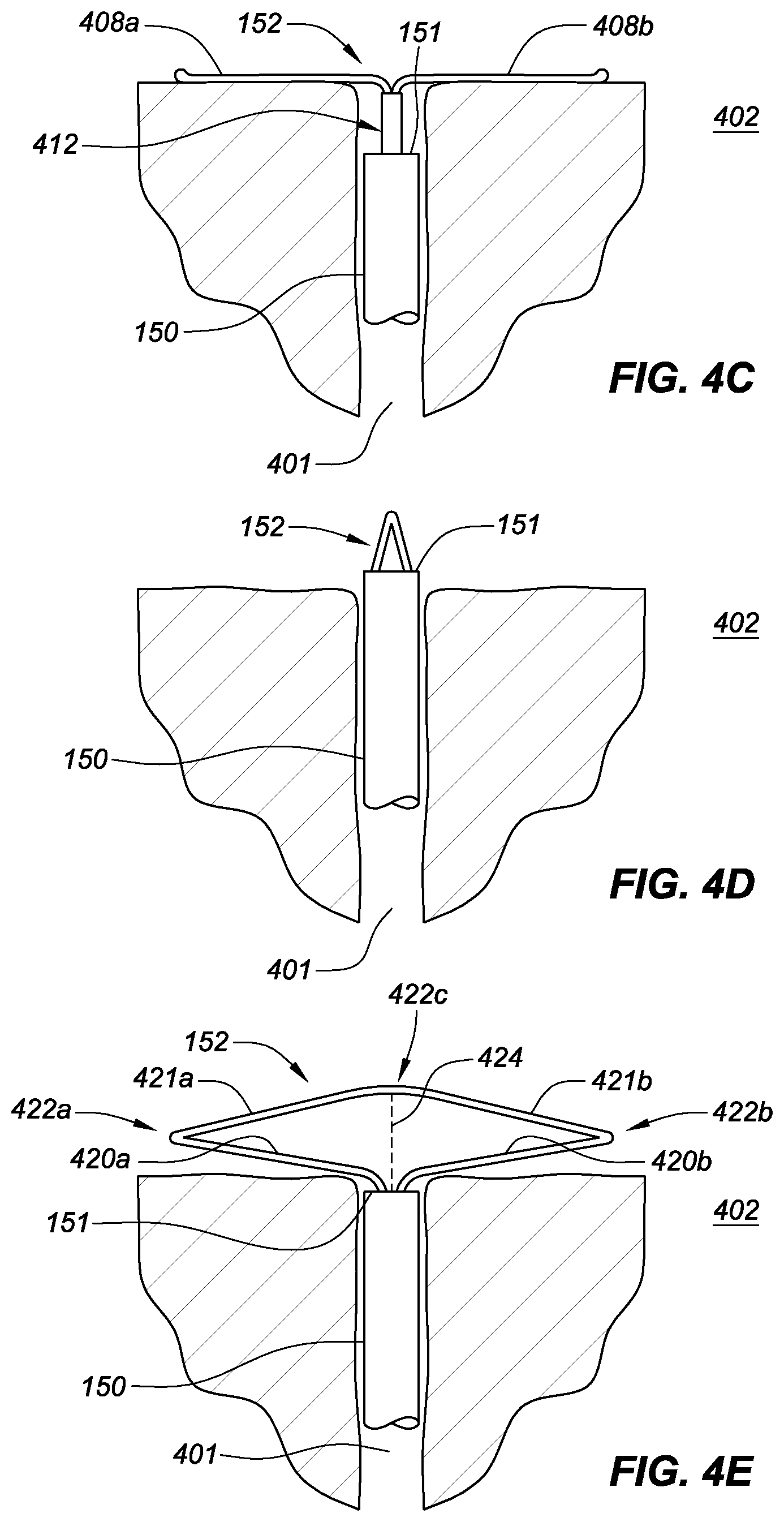 Patent US11771575 Figure 10 – Systems, devices, and methods for the accurate deployment and imaging of an implant in the prostatic urethra