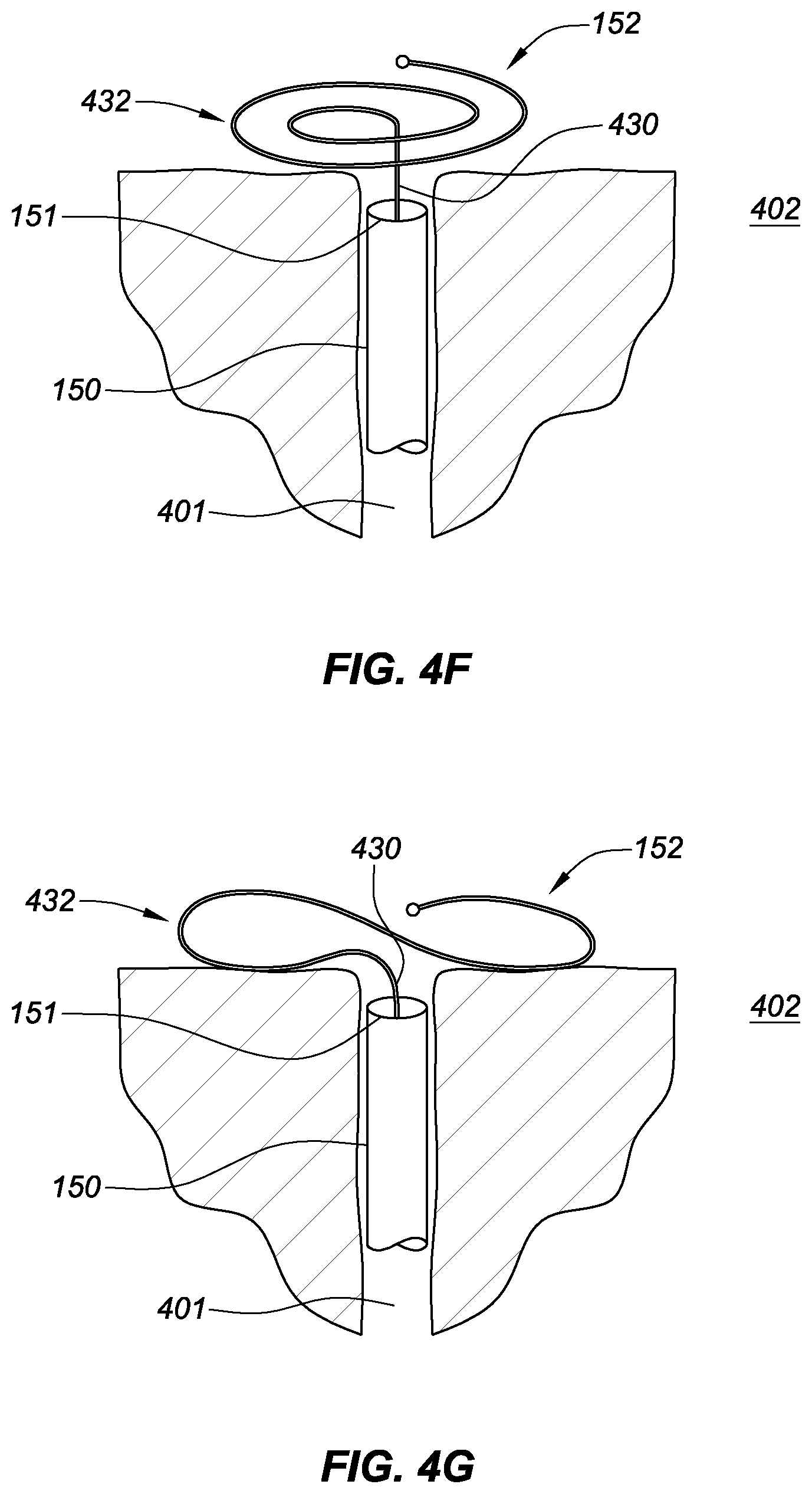 Patent US11771575 Figure 11 – Systems, devices, and methods for the accurate deployment and imaging of an implant in the prostatic urethra