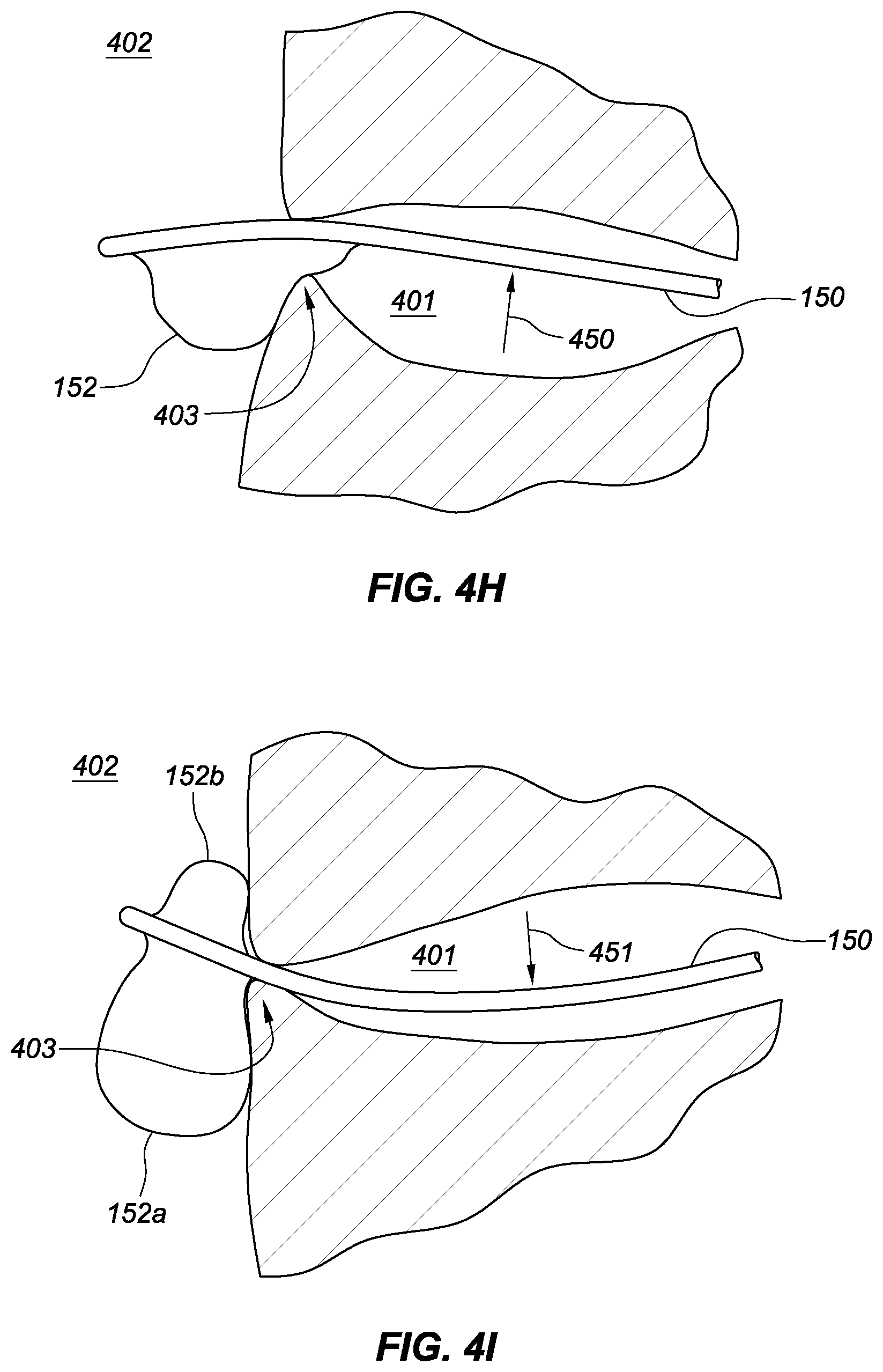 Patent US11771575 Figure 12 – Systems, devices, and methods for the accurate deployment and imaging of an implant in the prostatic urethra
