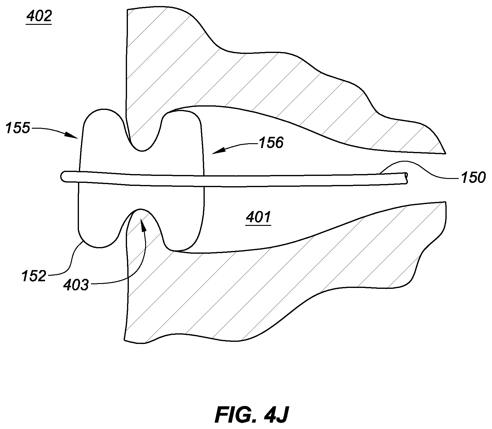 Patent US11771575 Figure 13 – Systems, devices, and methods for the accurate deployment and imaging of an implant in the prostatic urethra
