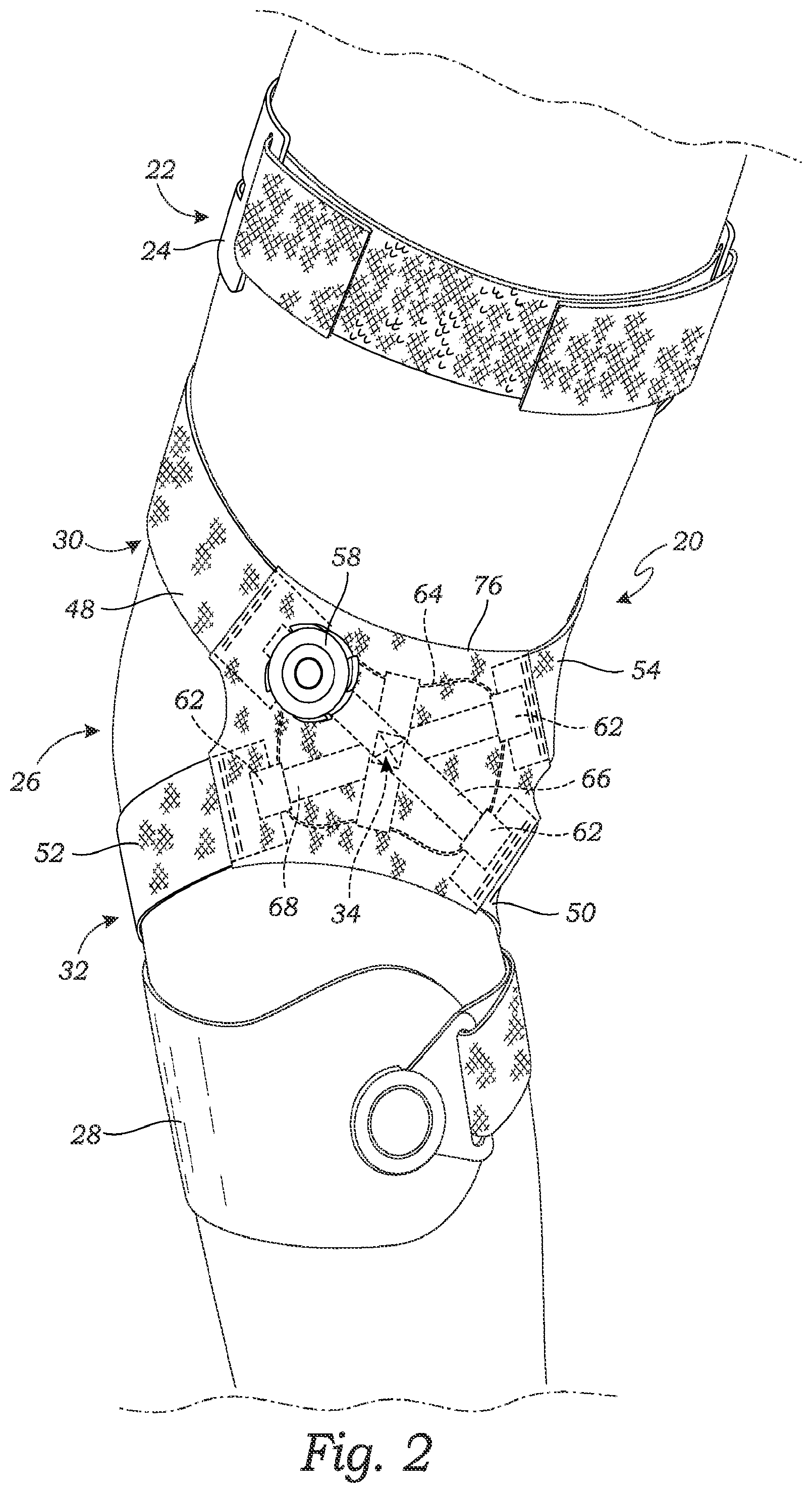 Patent US11771578 Figure 2 – Cross-strap tensioning apparatus for osteoarthritis braces