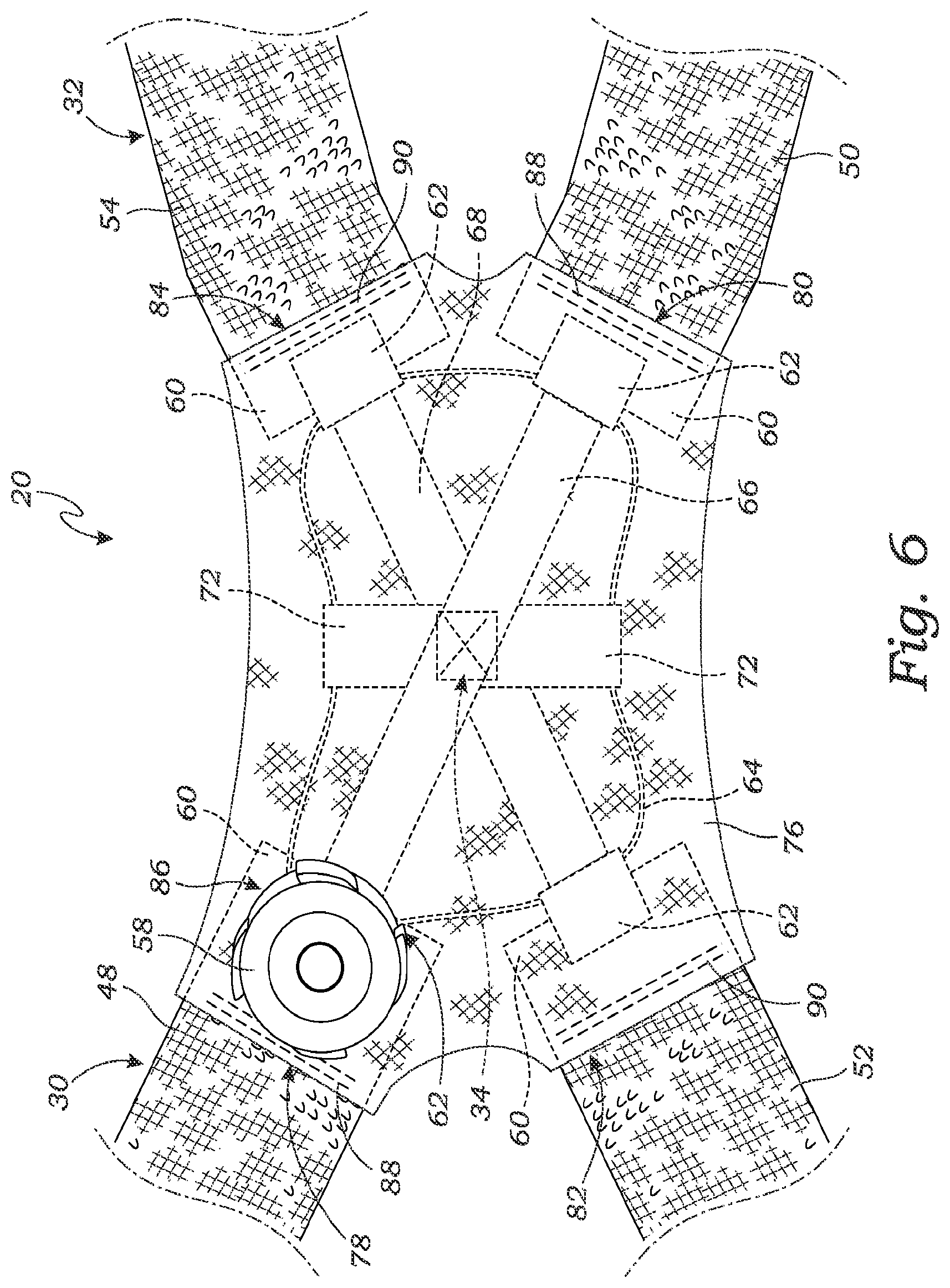 Patent US11771578 Figure 6 – Cross-strap tensioning apparatus for osteoarthritis braces