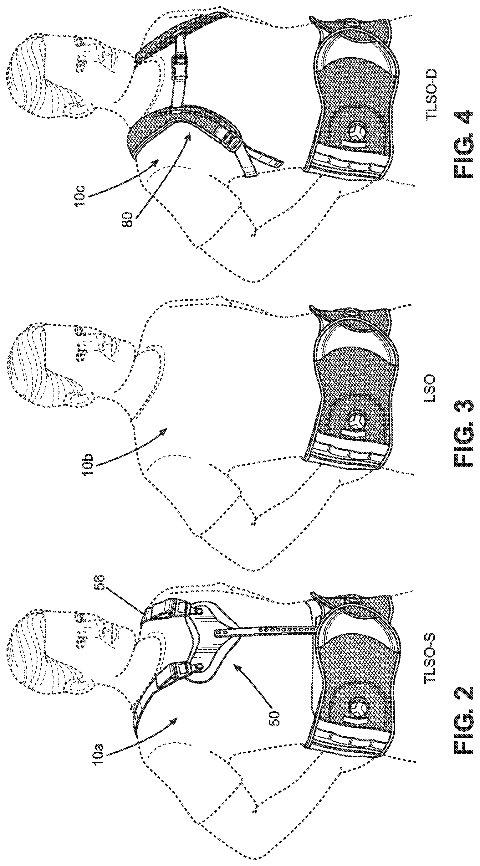 Patent US11771580 Figure 2 – TLSO/LSO spine brace