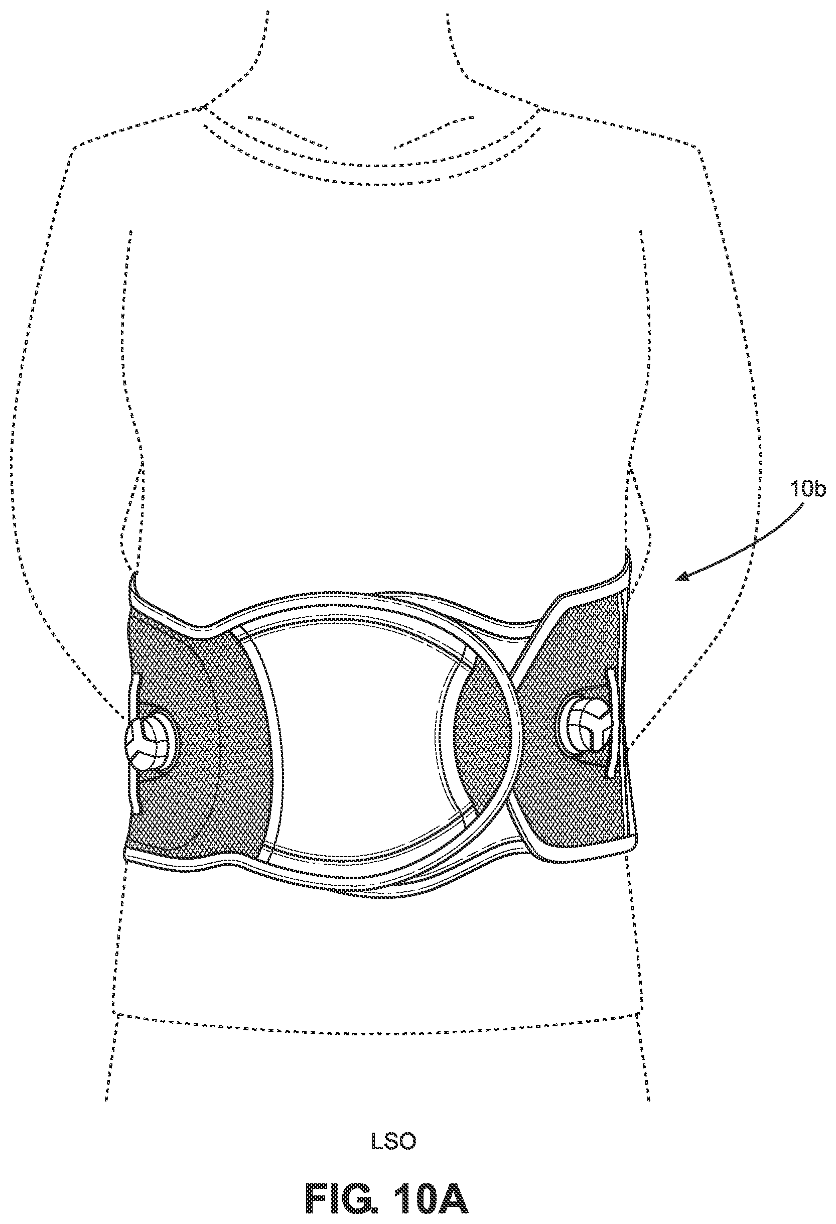 Patent US11771580 Figure 16 – TLSO/LSO spine brace