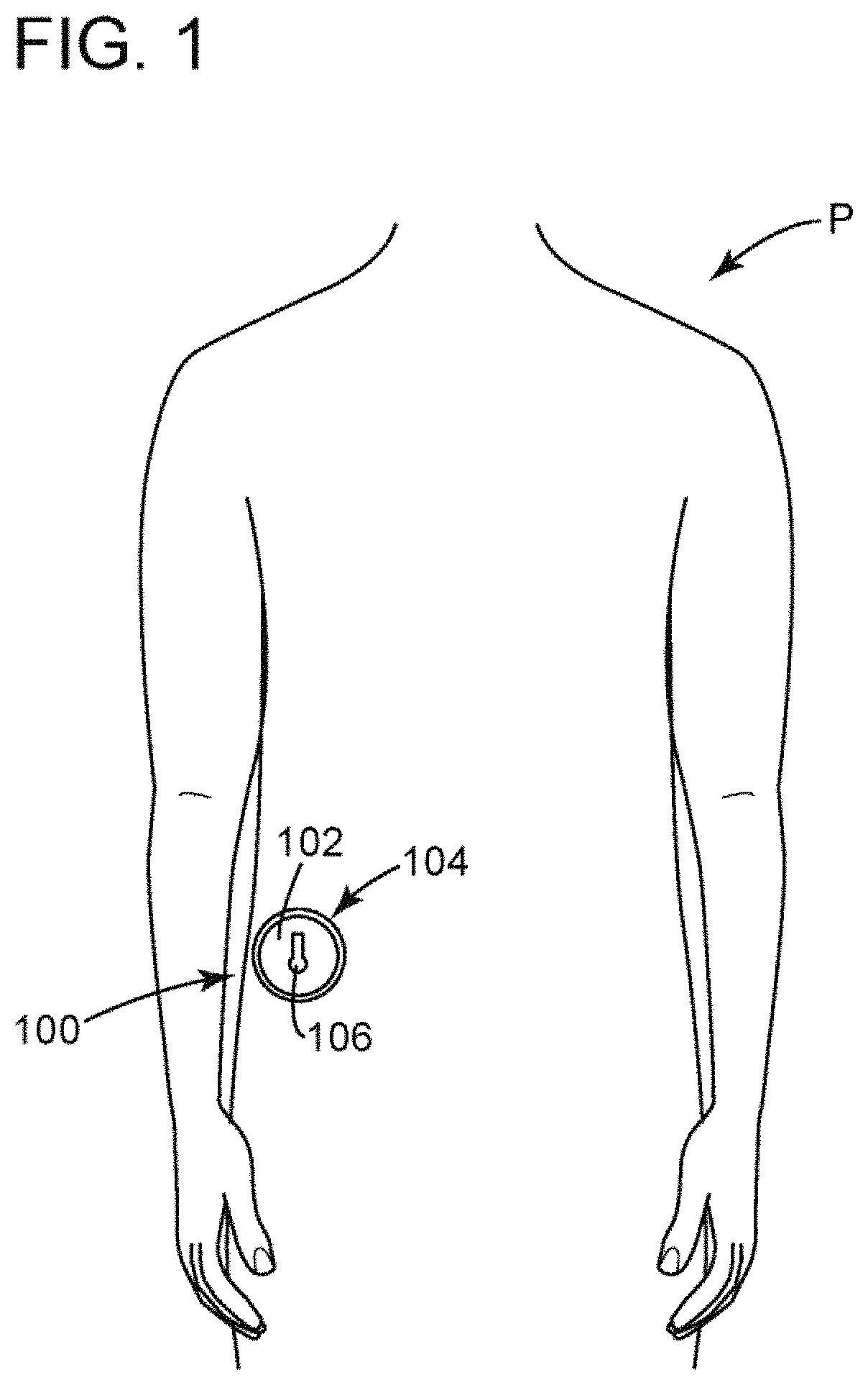 Patent US11771585 Figure 1 – Devices, systems and methods for regulating flow from a stoma on a patient