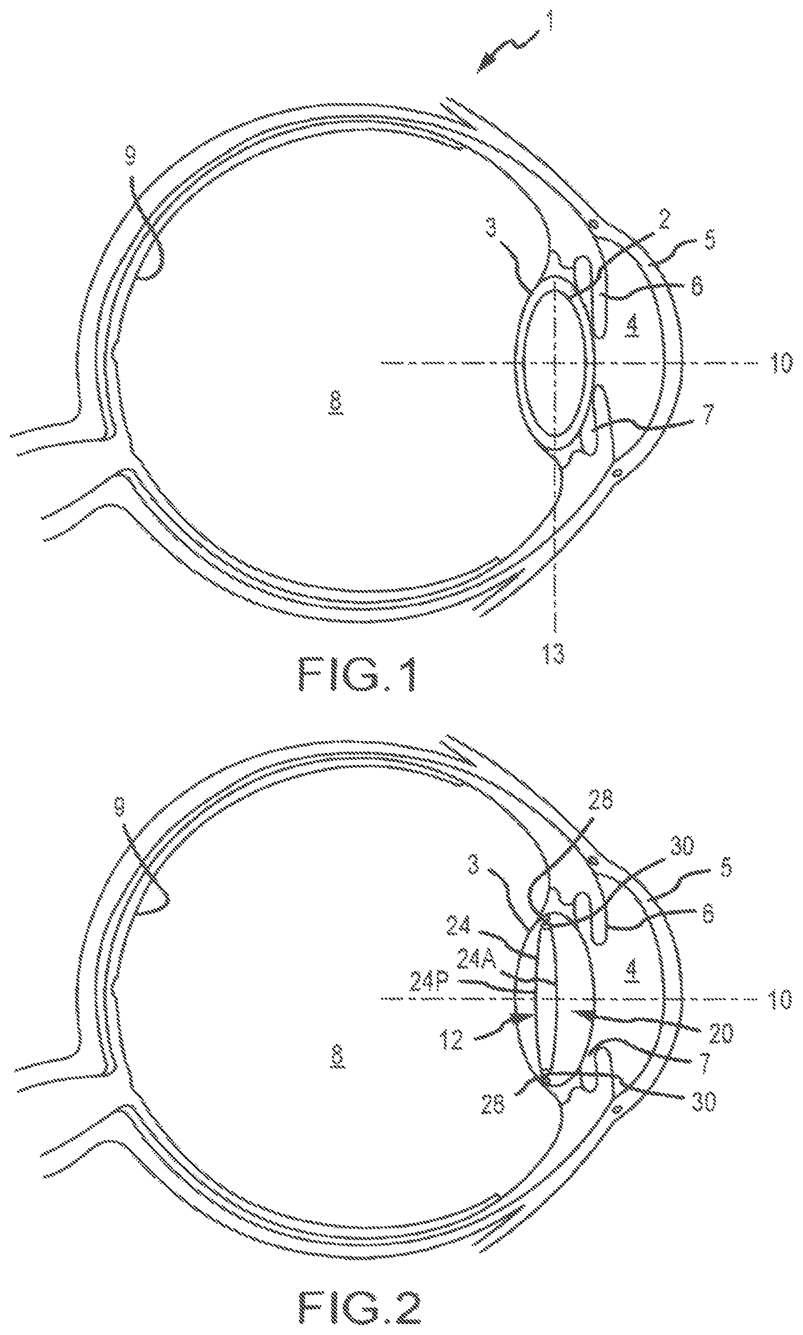 Patent US11771592 Figure 1 – Stabilized intraocular drug delivery systems and methods of use