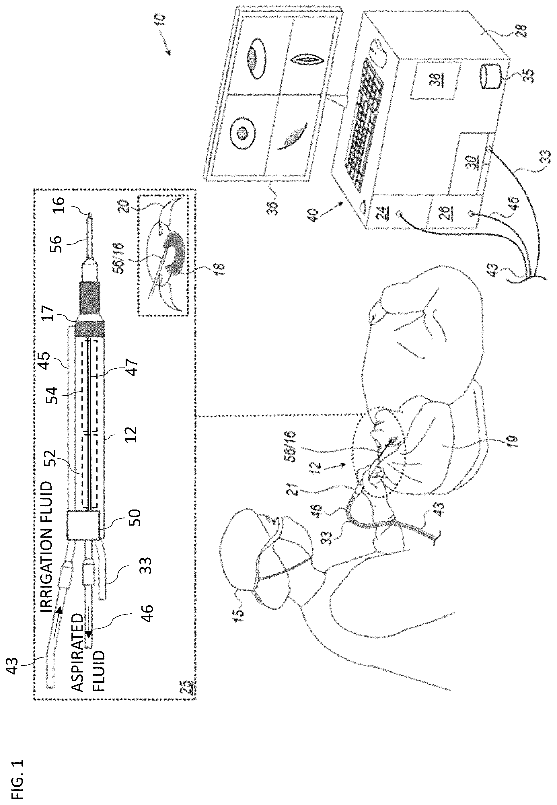 Patent US11771594 — Controlling intraocular pressure during phacoemulsification procedure — Figure 1