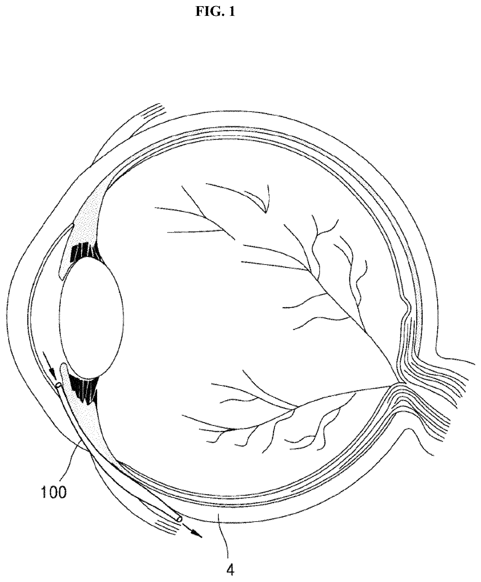 Patent US11771595 Figure 1 – Implant device for eye disease for adjusting intraocular pressure