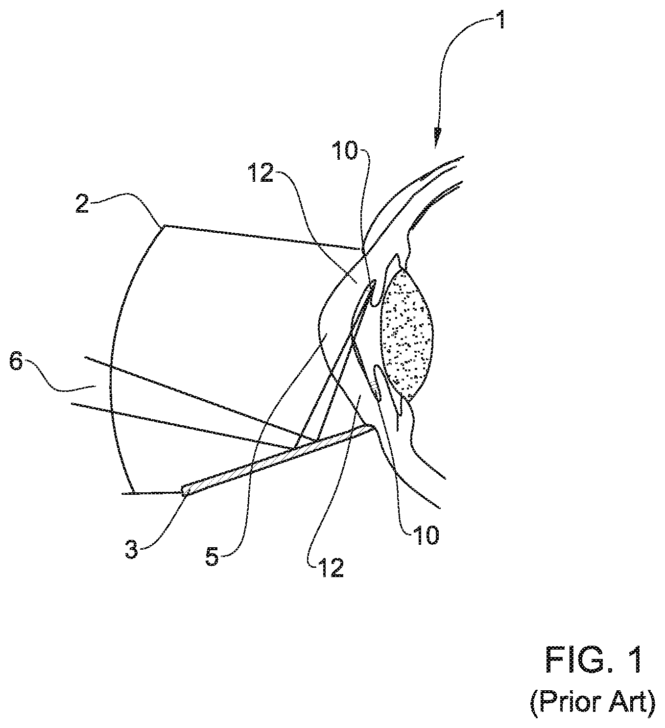 Patent US11771596 Figure 1 – System and method for treating an eye