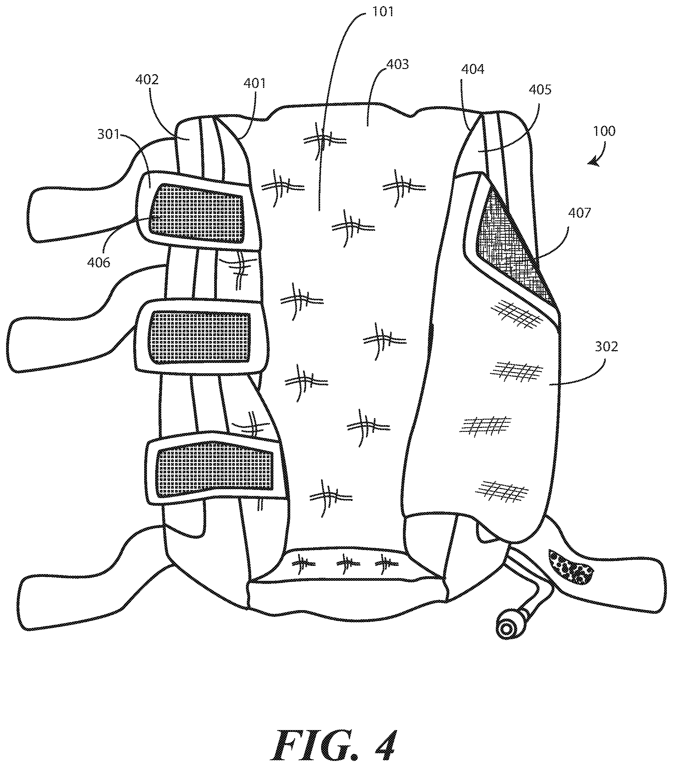 Patent US11771616 Figure 4 – Heel protector and corresponding rehabilitation systems and methods for using the same